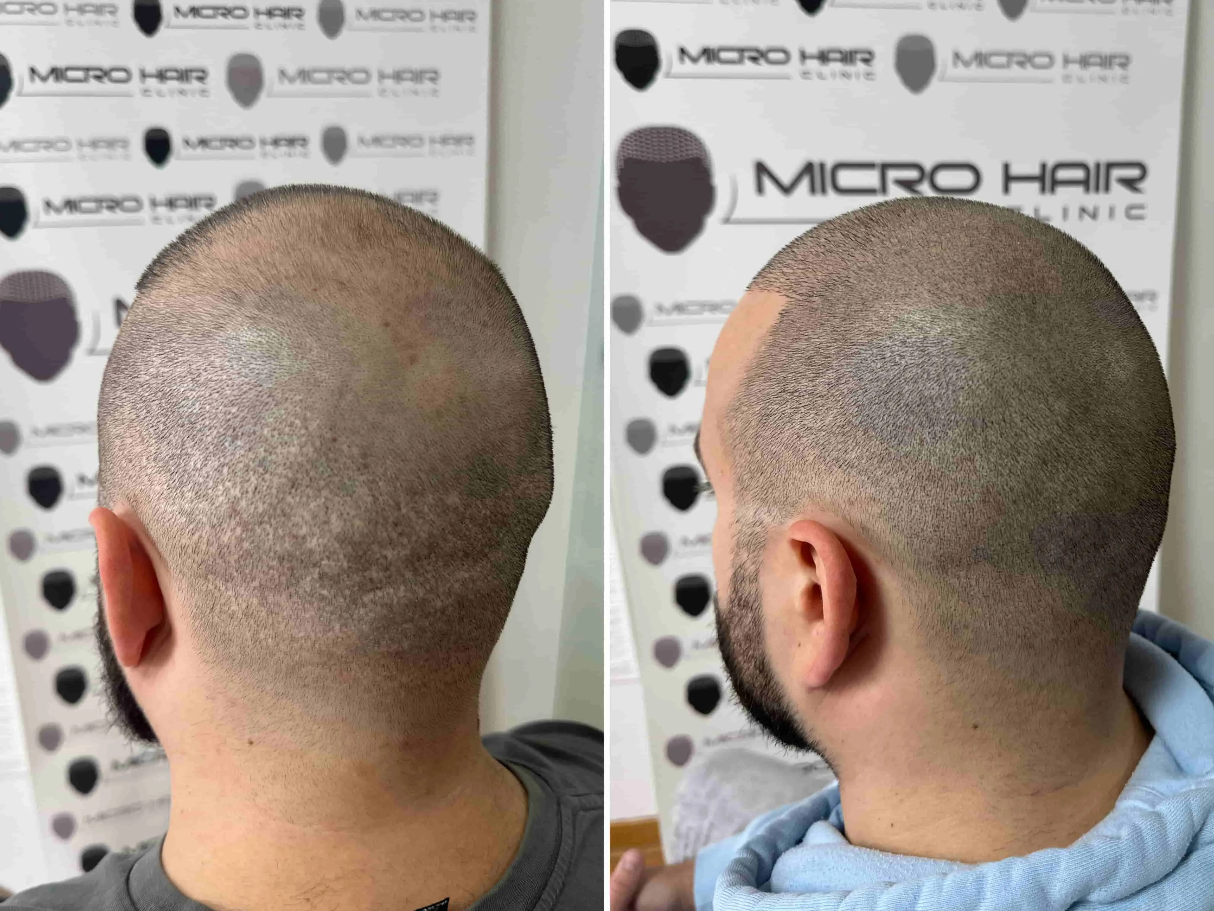 SMP rezultat pred in po - tretman mikropigmentacije 5