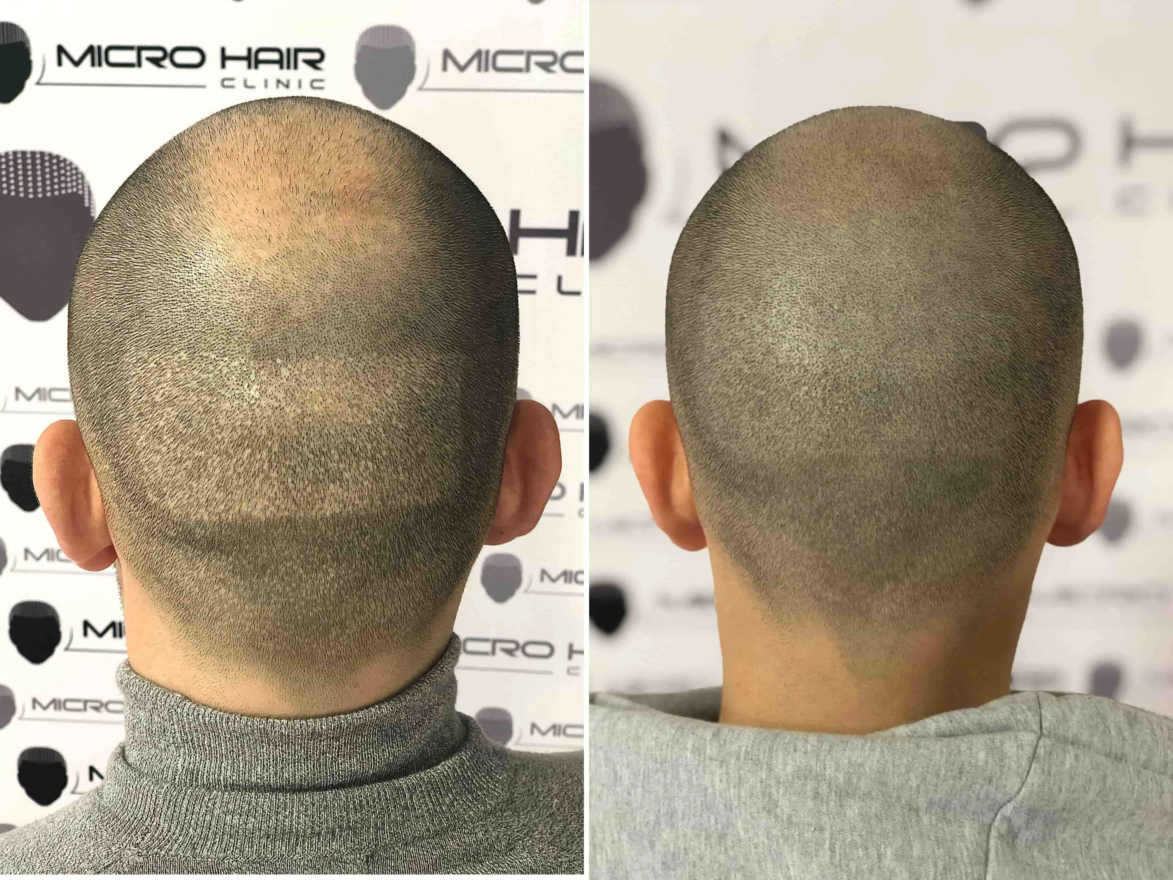 SMP rezultat pred in po - tretman mikropigmentacije 9