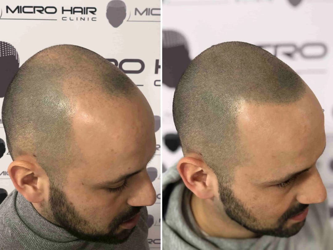 SMP tretma pigmentacija za kamuflažo brazgotine na glavi