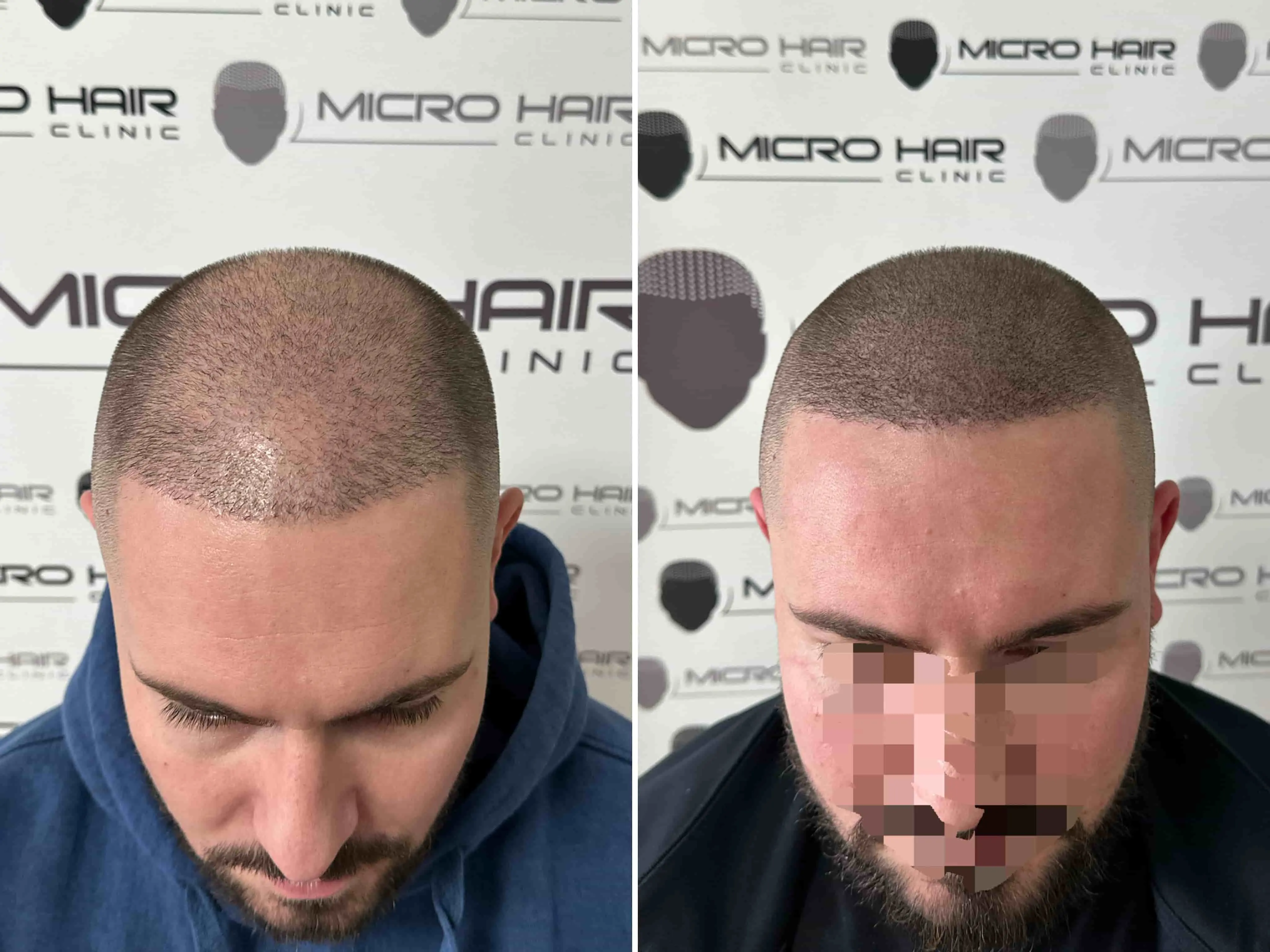 SMP rezultat pred in po - tretman mikropigmentacije 12