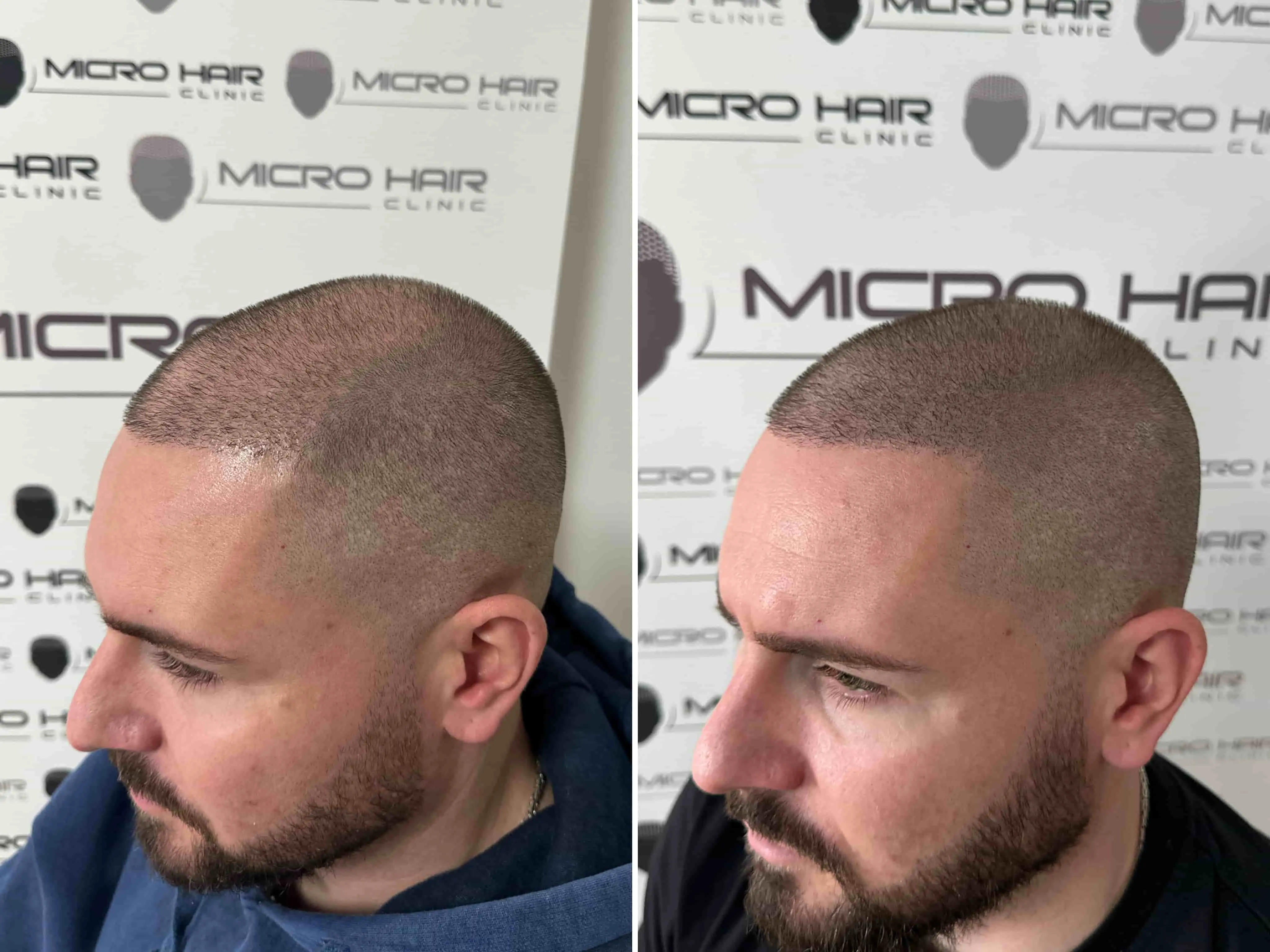 SMP rezultat pred in po - tretman mikropigmentacije 14