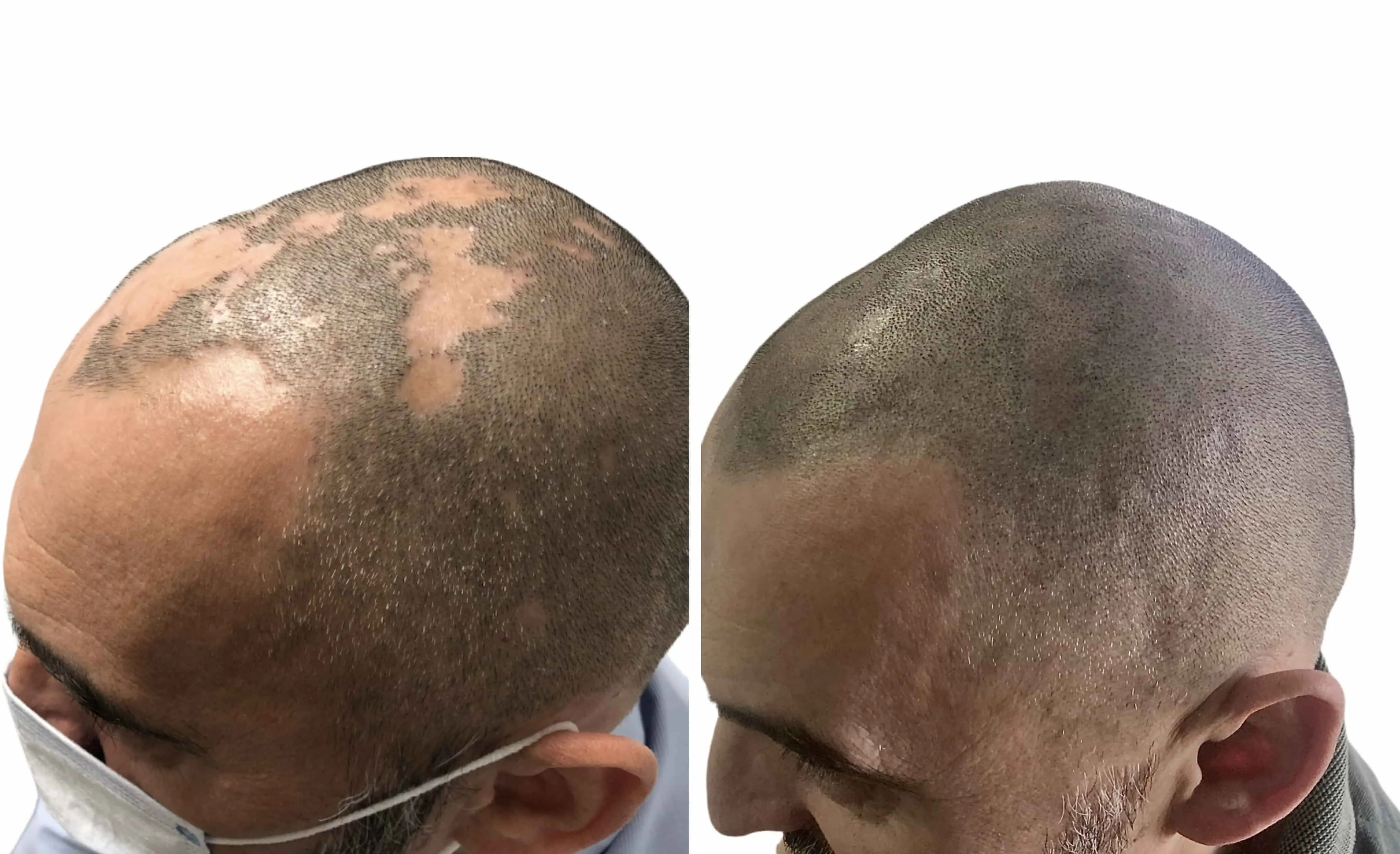 SMP rezultat pred in po - tretman mikropigmentacije 4