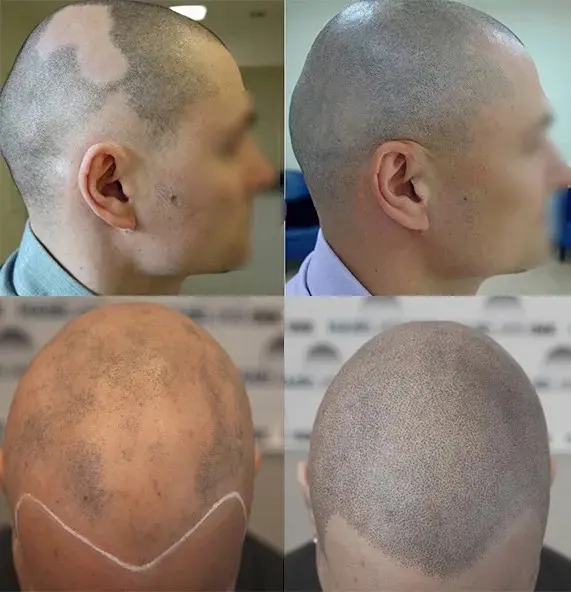 SMP rezultat pred in po - tretman mikropigmentacije 5