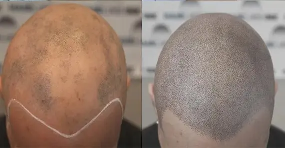 SMP rezultat pred in po - tretman mikropigmentacije 6