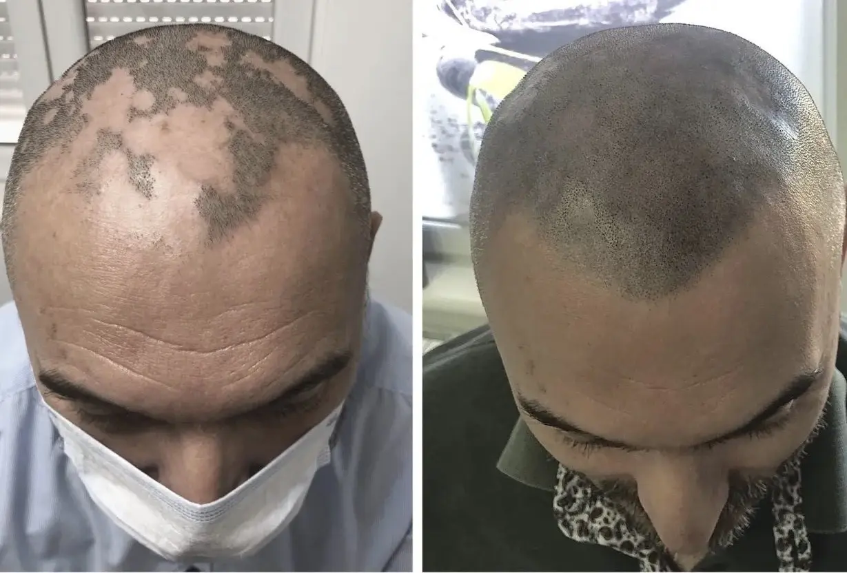 SMP rezultat pred in po - tretman mikropigmentacije 7