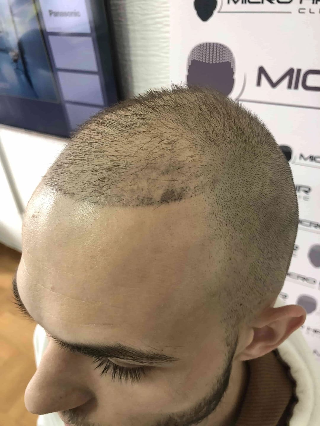 SMP tretman - fotografija iz galerije Micro Hair Clinic