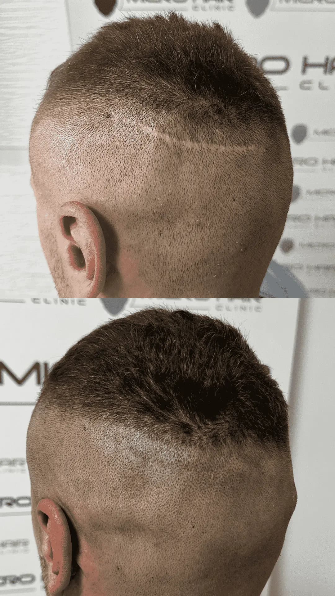 SMP mikropigmentacija rezultat – prekrita brazgotina na lasišču