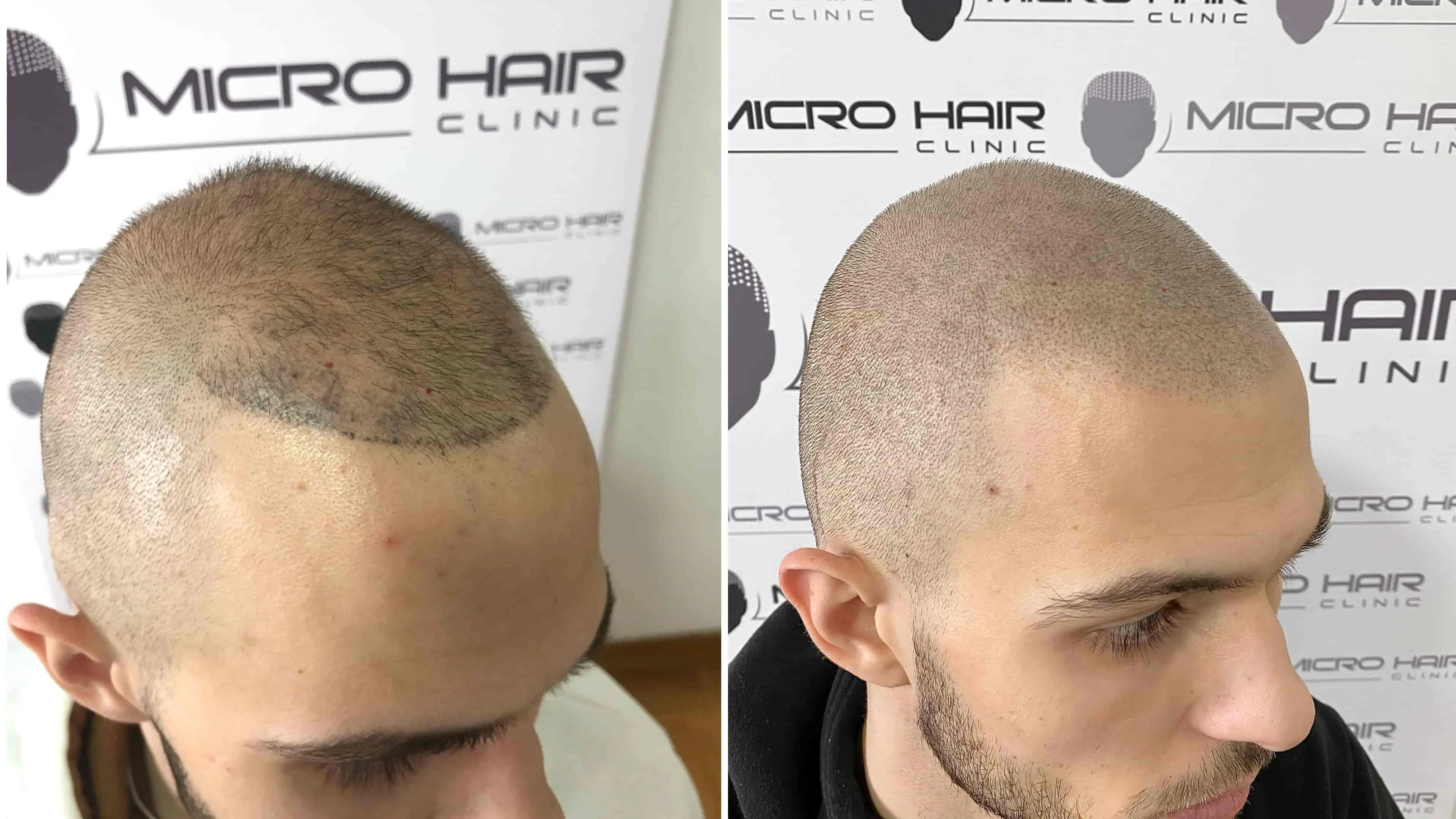 Popravek slabo izvedene mikropigmentacije lasišča – prej in potem