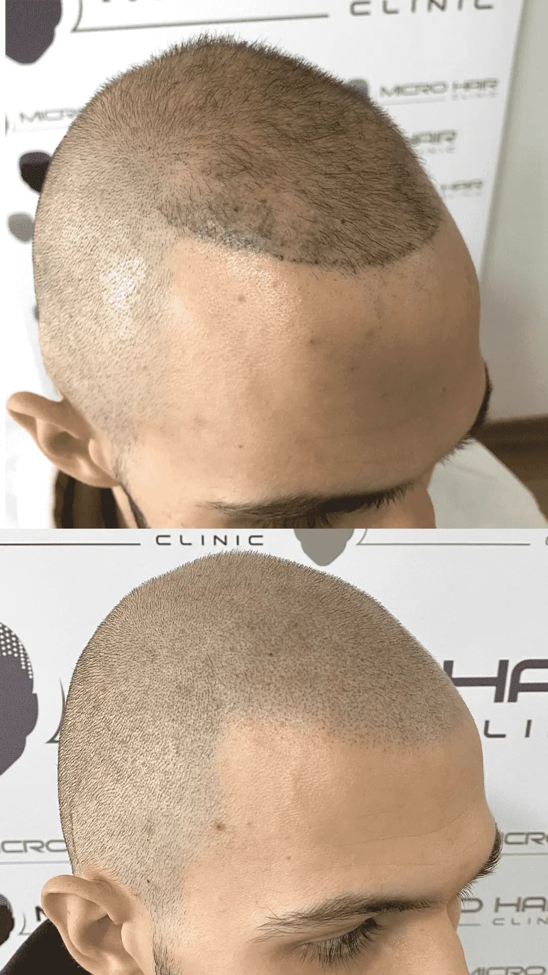 Popravek slabo izvedene mikropigmentacije lasišča – prej in potem