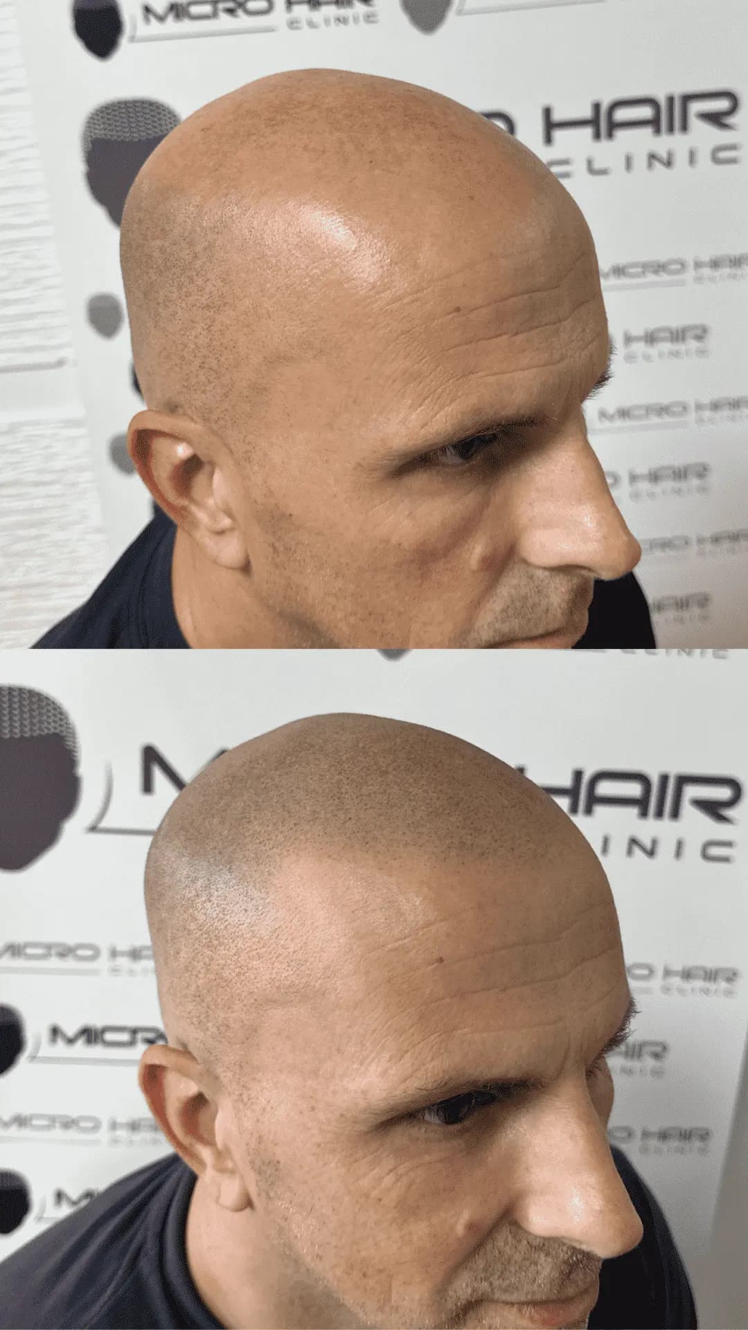 SMP mikropigmentacija rezultat pri moškem z plešavostjo (Norwood 6)