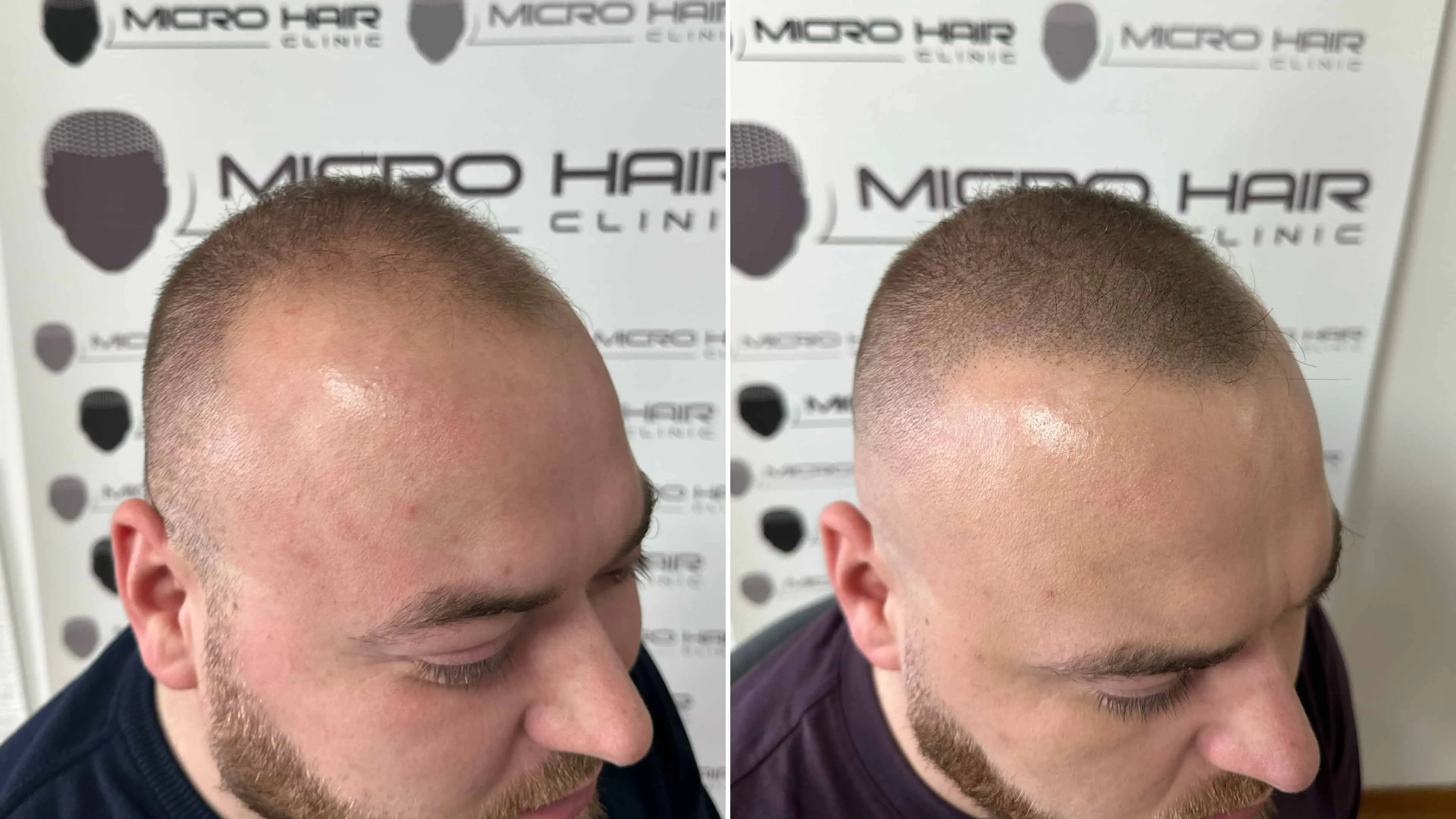 SMP mikropigmentacija povecanje gostote redki lasje