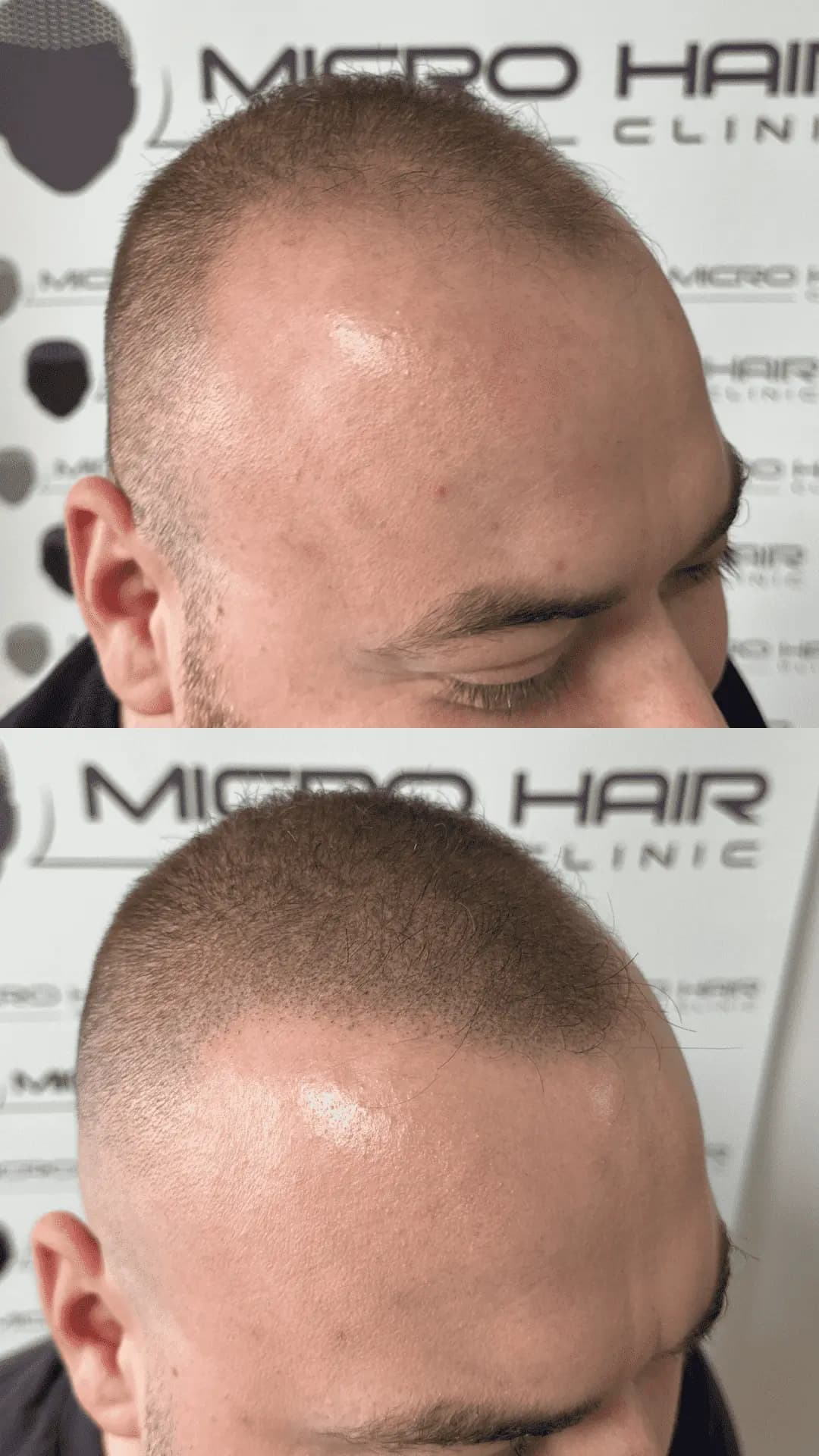 SMP mikropigmentacija povecanje gostote redki lasje