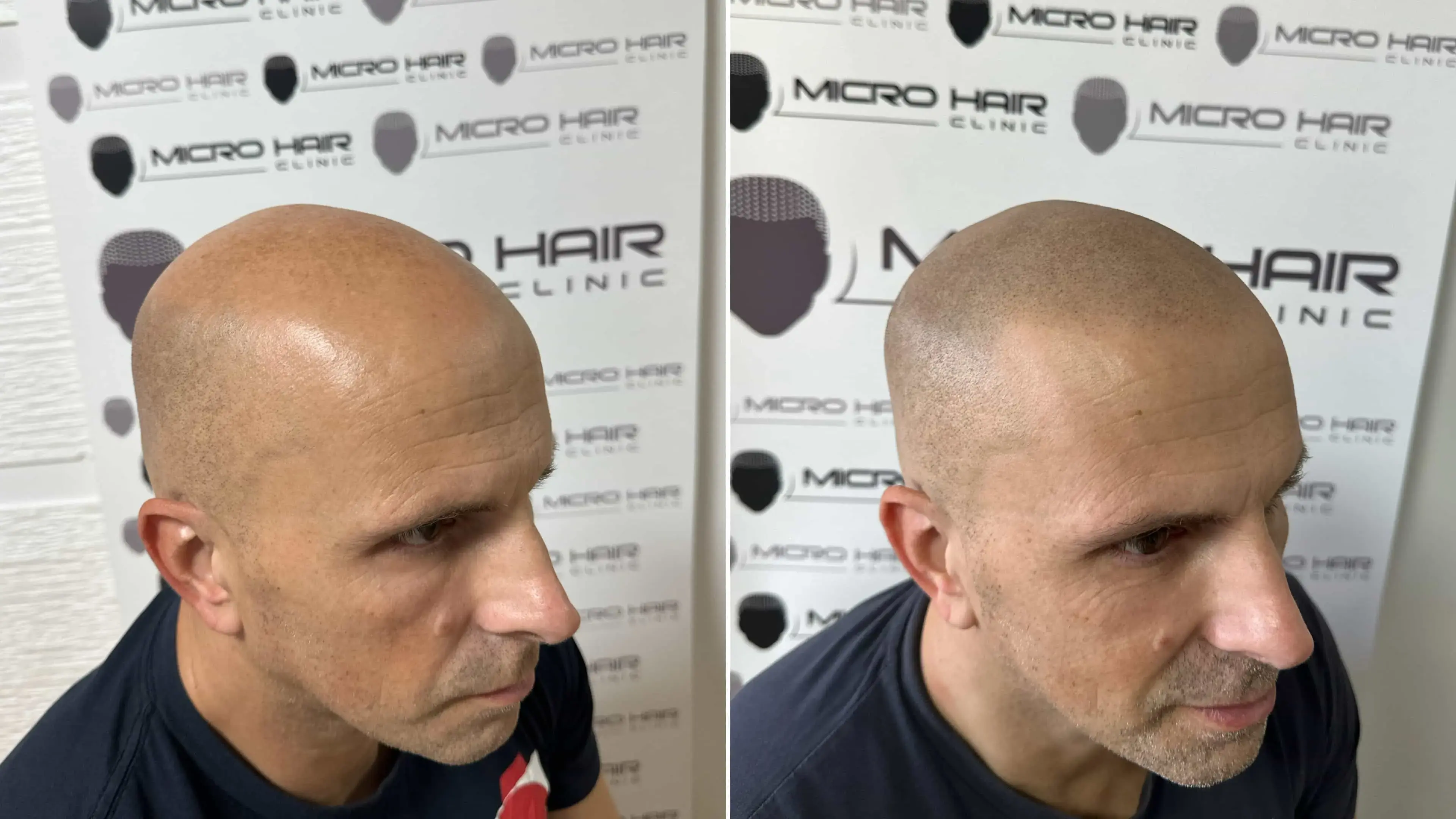 SMP mikropigmentacija rezultat pri moškem z plešavostjo (Norwood 6)