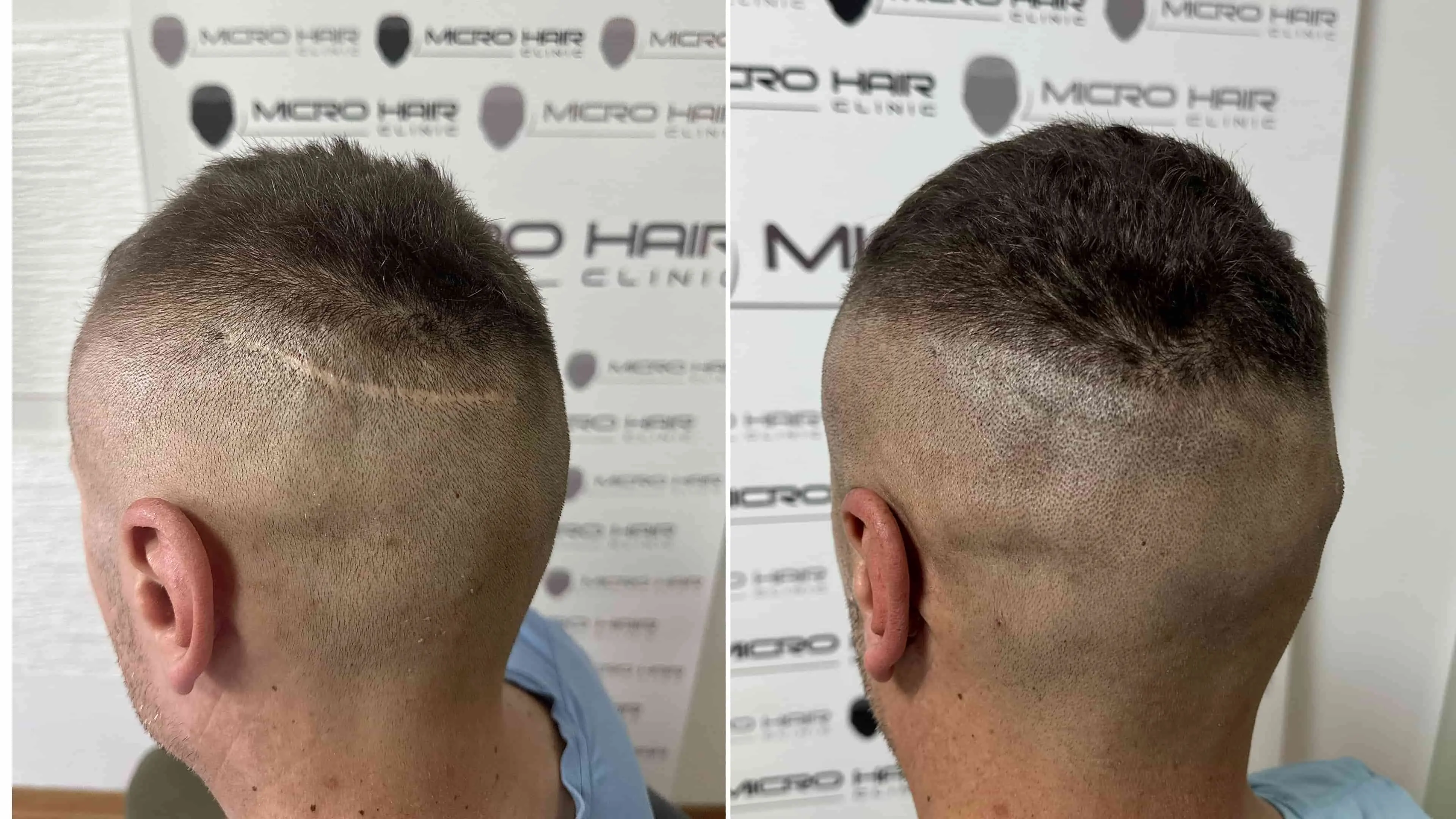 SMP mikropigmentacija rezultat – prekrita brazgotina na lasišču