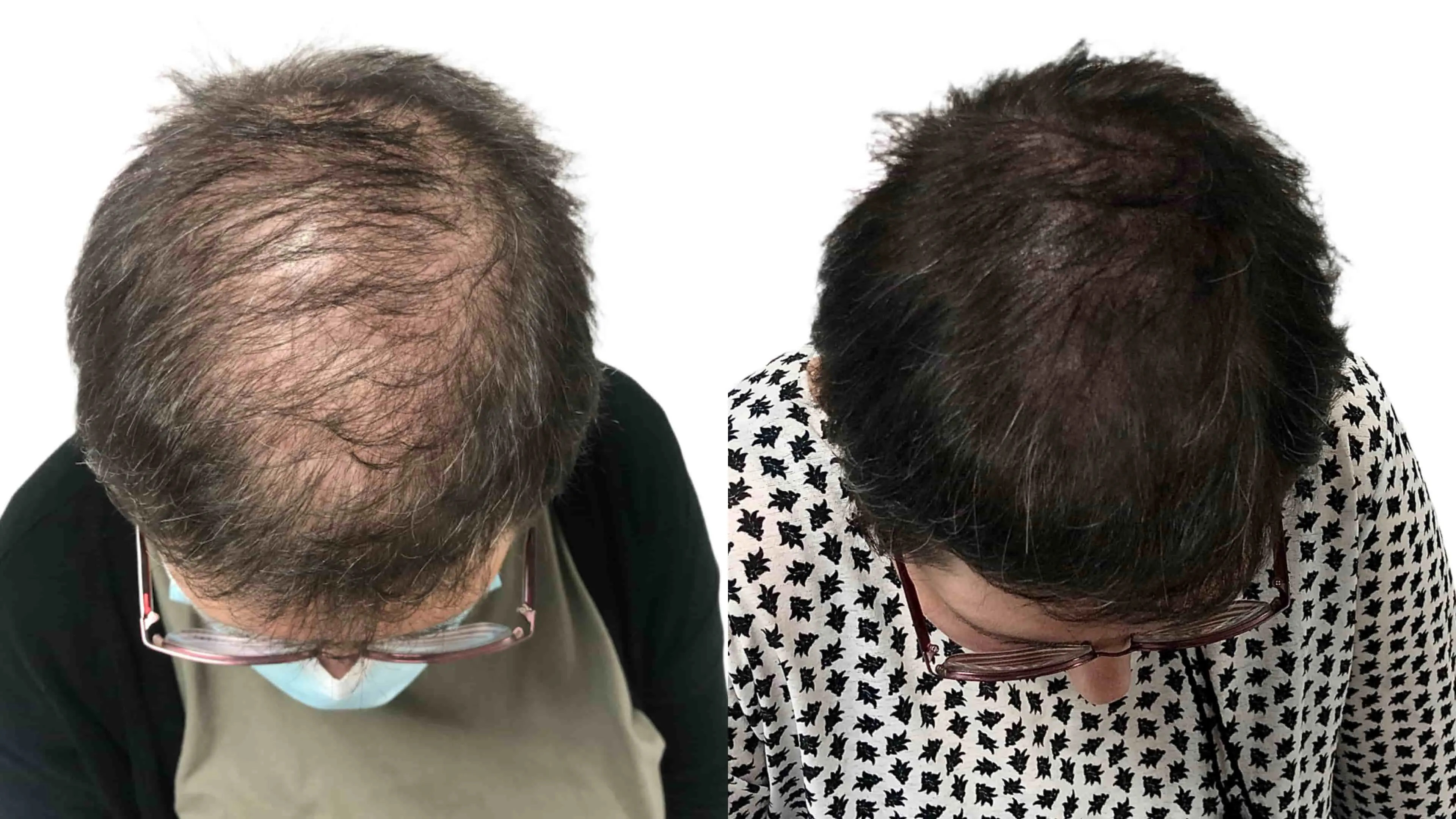 Rezultat SMP mikropigmentacija pri ženski z redkimi lasmi na temenu