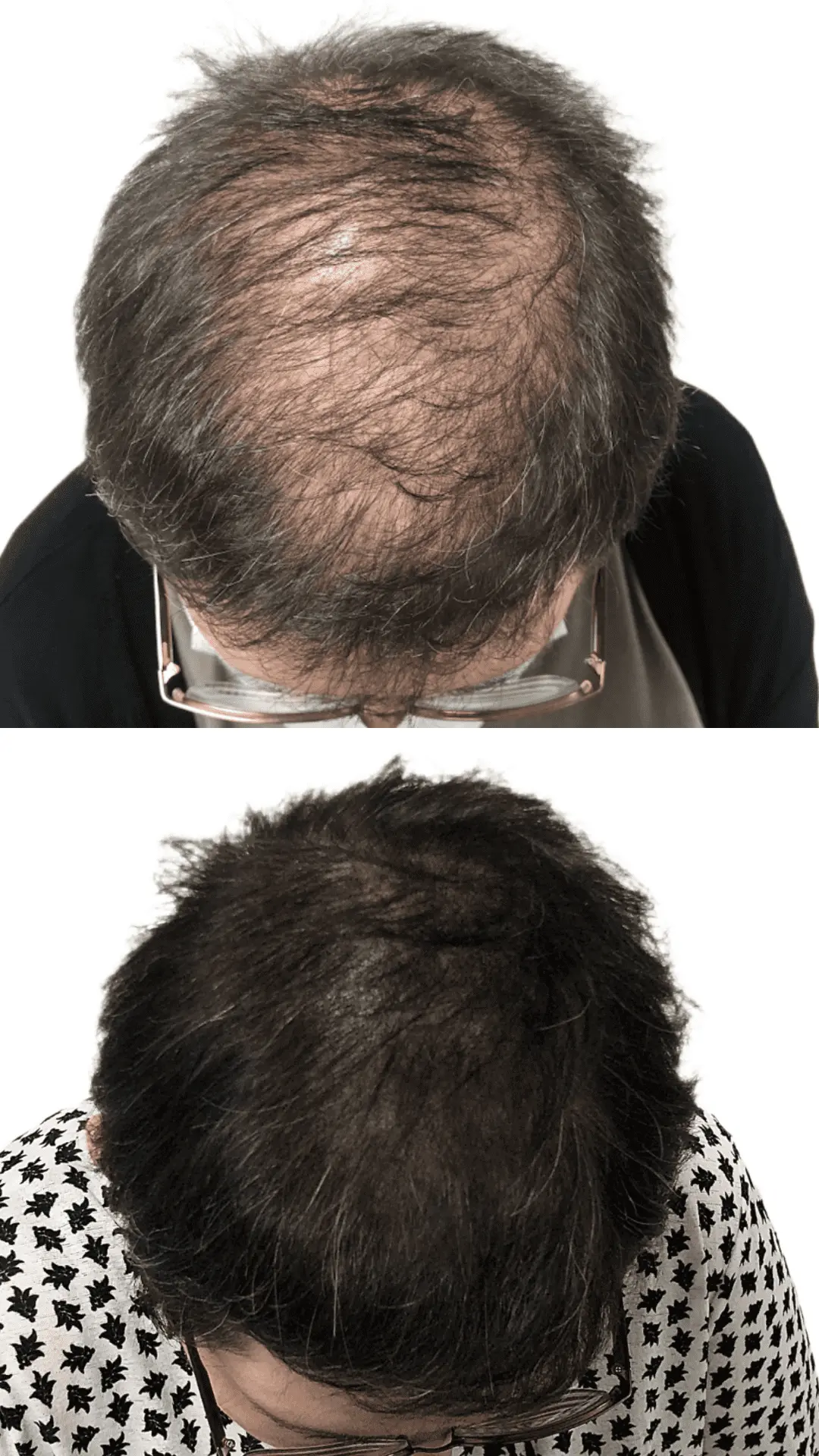 Rezultat SMP mikropigmentacija pri ženski z redkimi lasmi na temenu