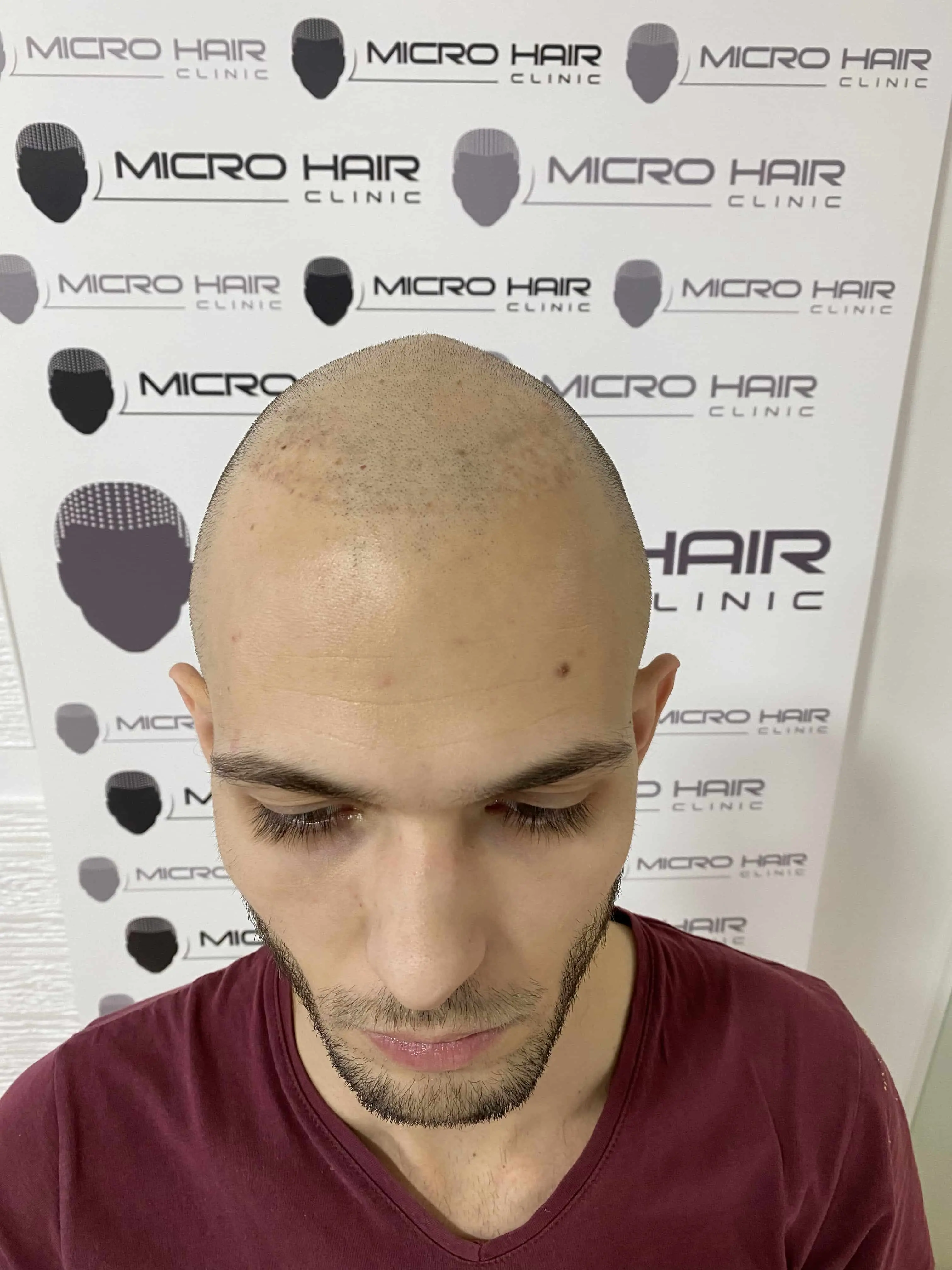 SMP tretman - fotografija iz galerije Micro Hair Clinic