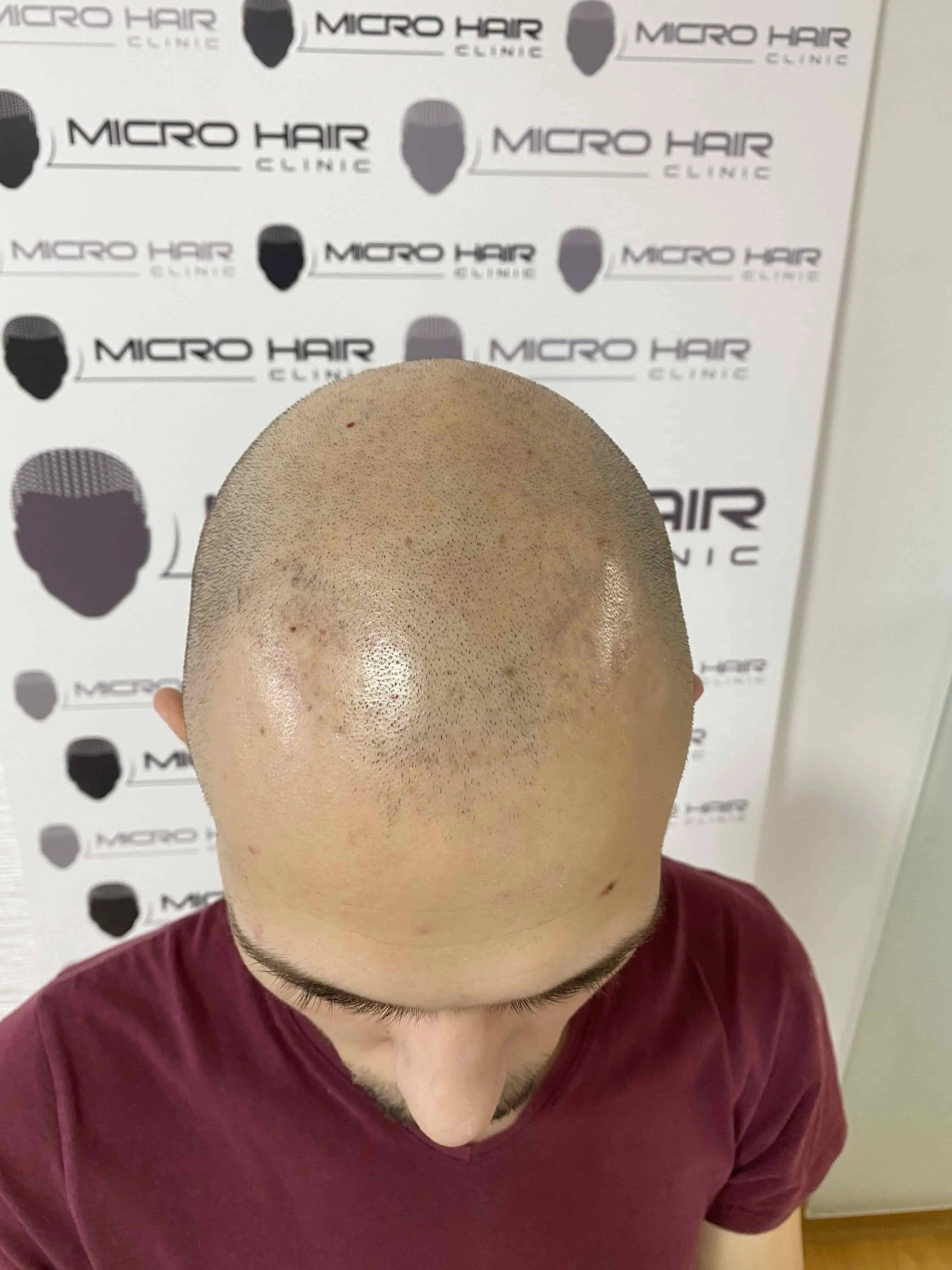 SMP tretman - fotografija iz galerije Micro Hair Clinic