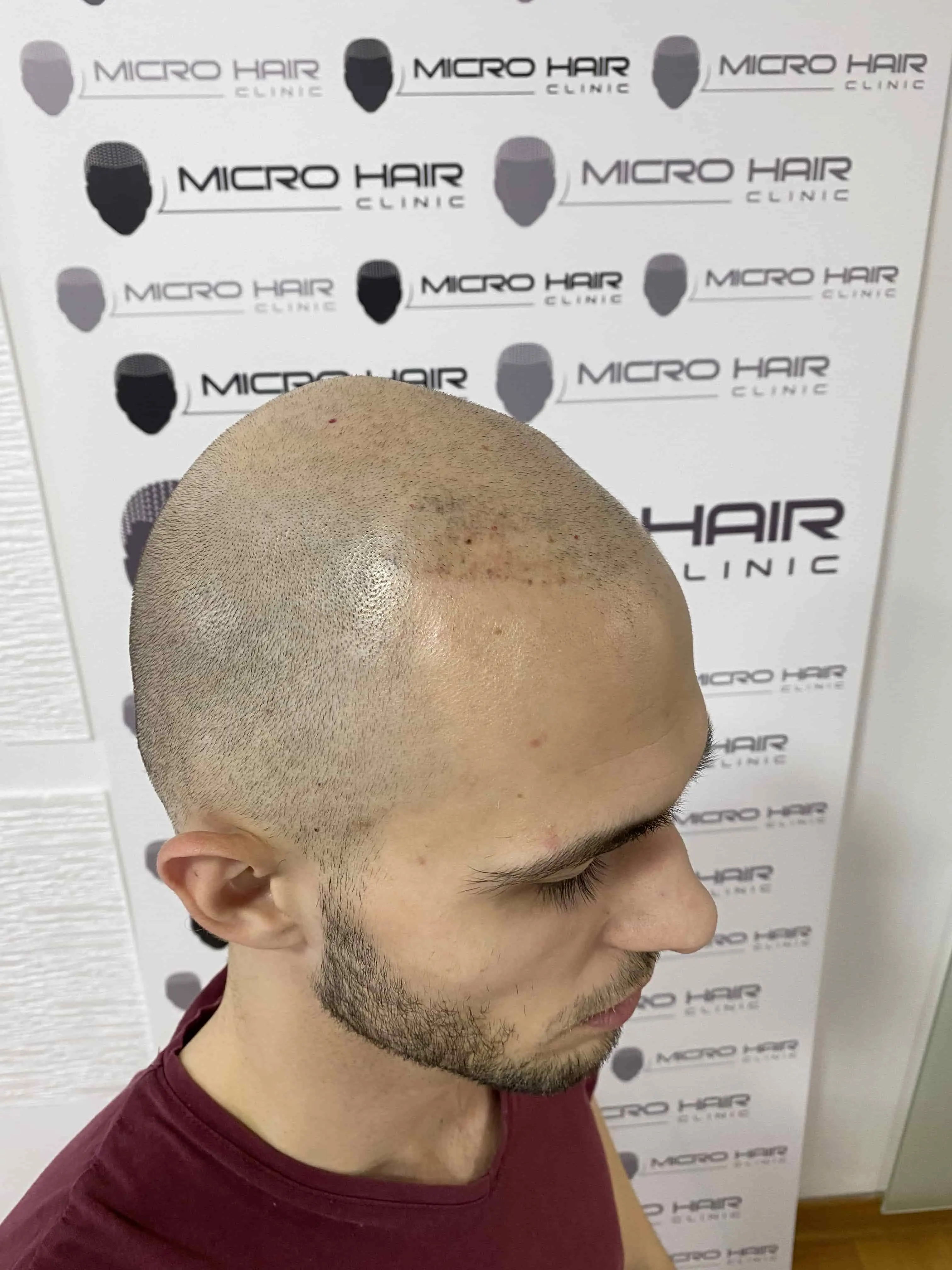 SMP tretman - fotografija iz galerije Micro Hair Clinic