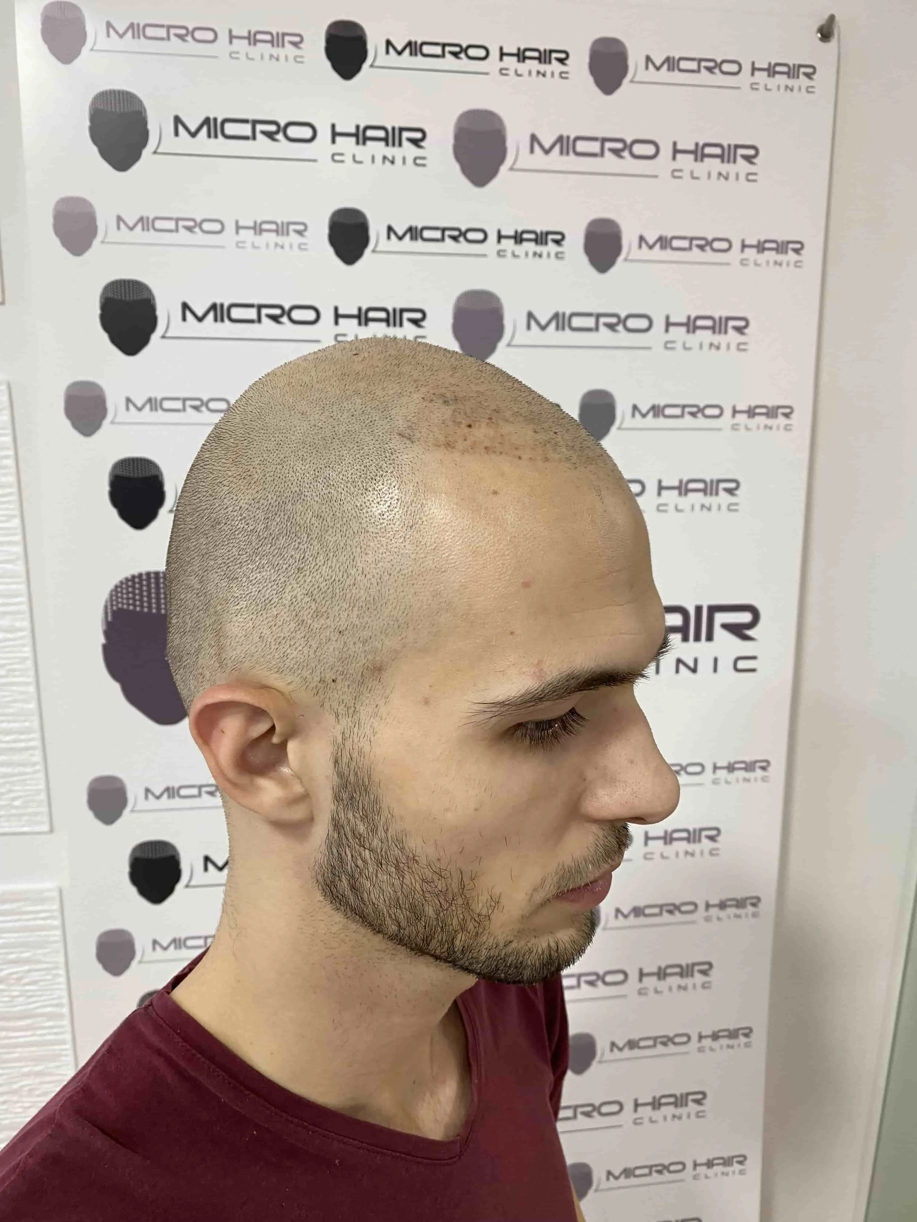 SMP tretman - fotografija iz galerije Micro Hair Clinic