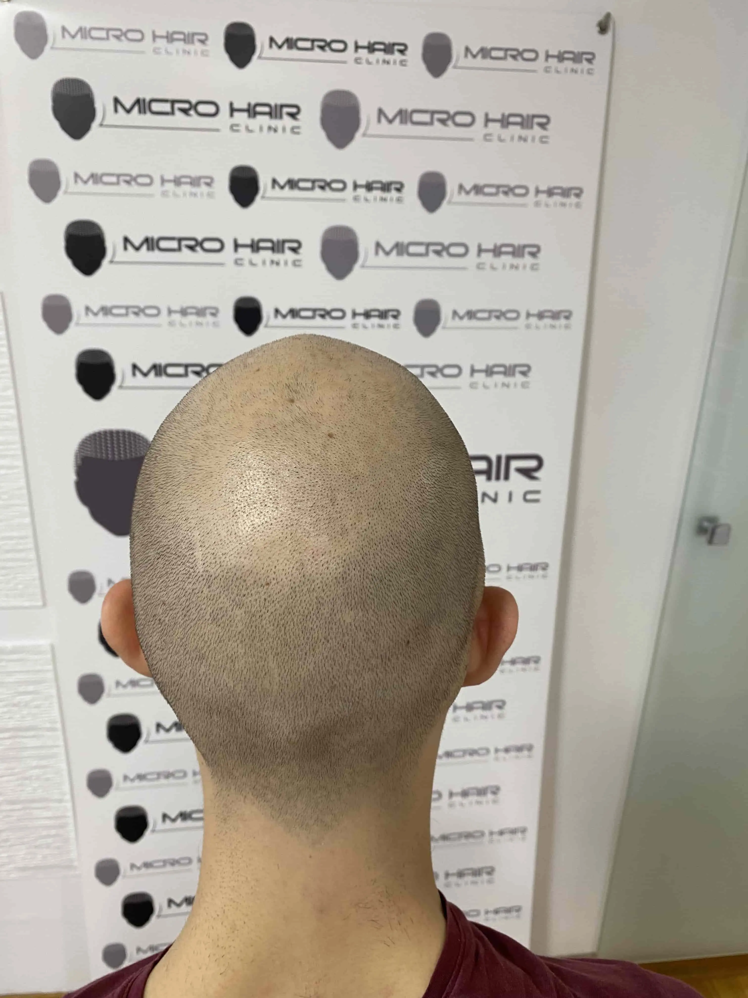 SMP tretman - fotografija iz galerije Micro Hair Clinic