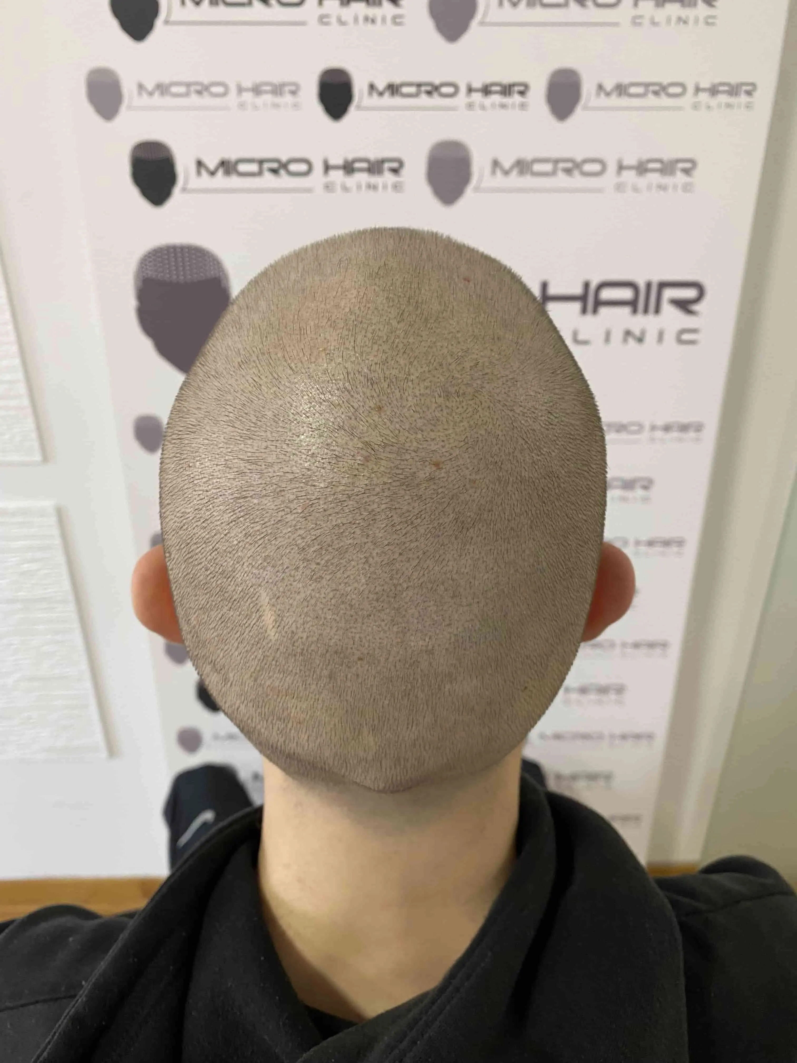 SMP tretman - fotografija iz galerije Micro Hair Clinic