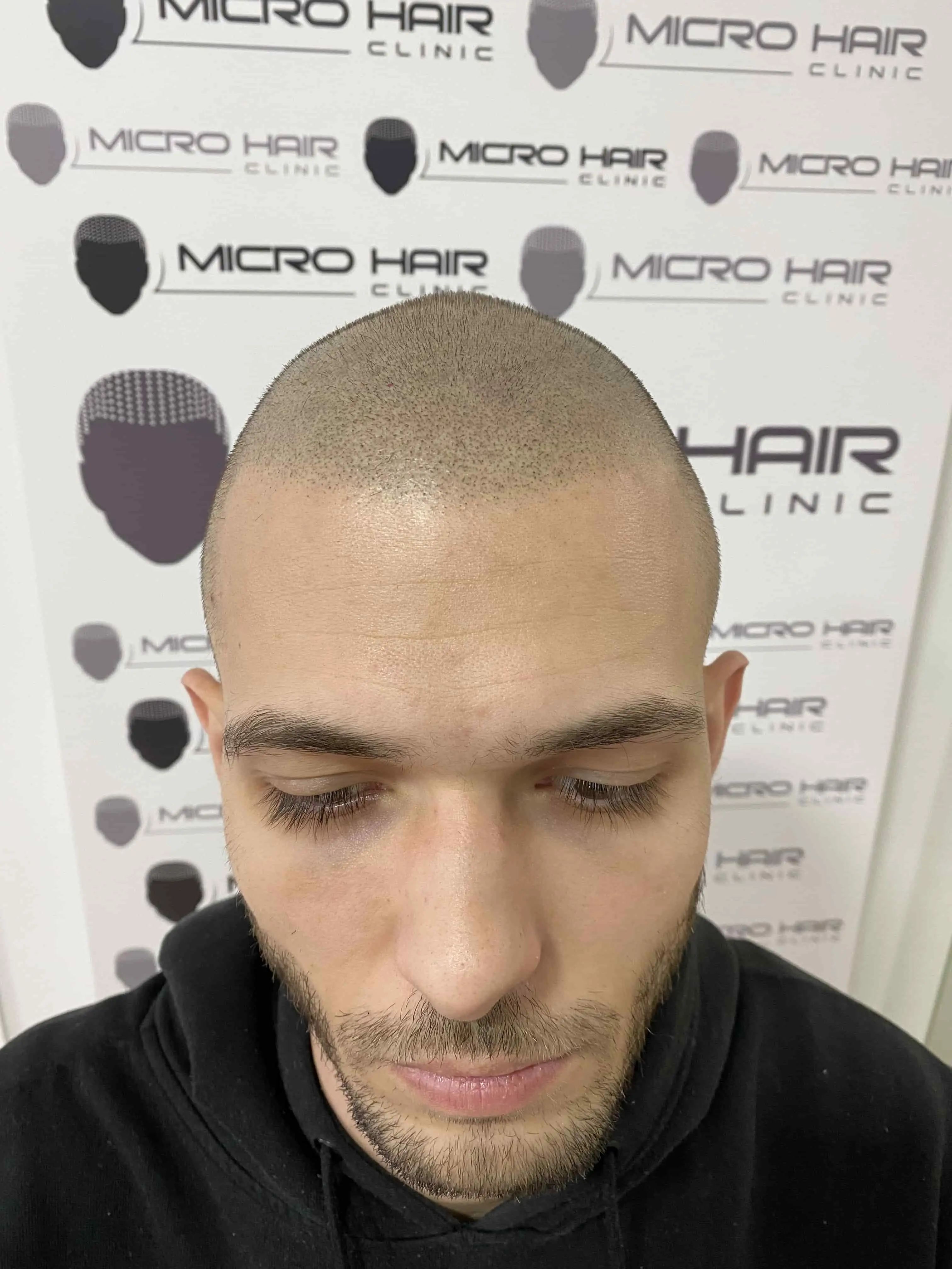 SMP tretman - fotografija iz galerije Micro Hair Clinic