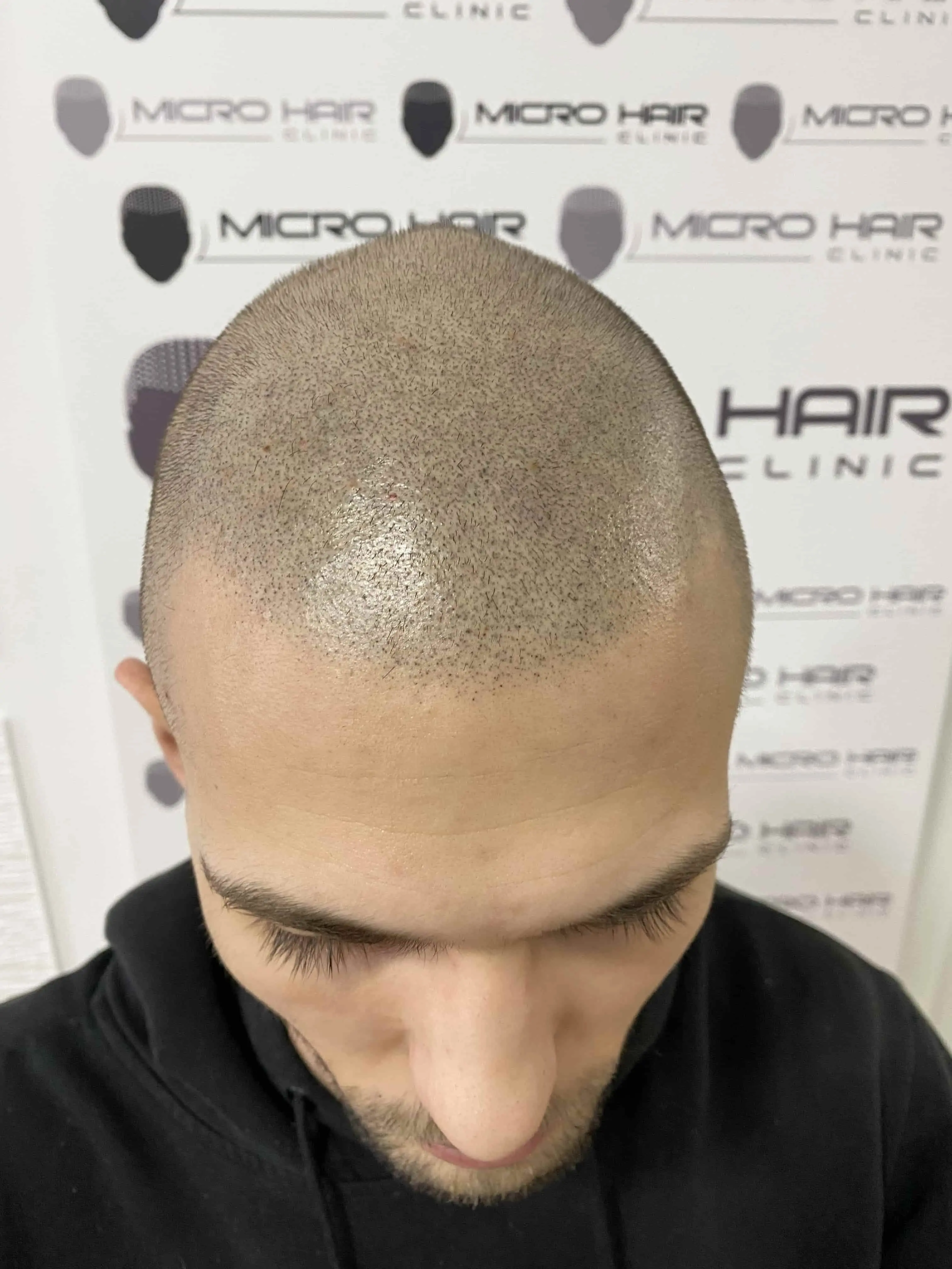 SMP tretman - fotografija iz galerije Micro Hair Clinic