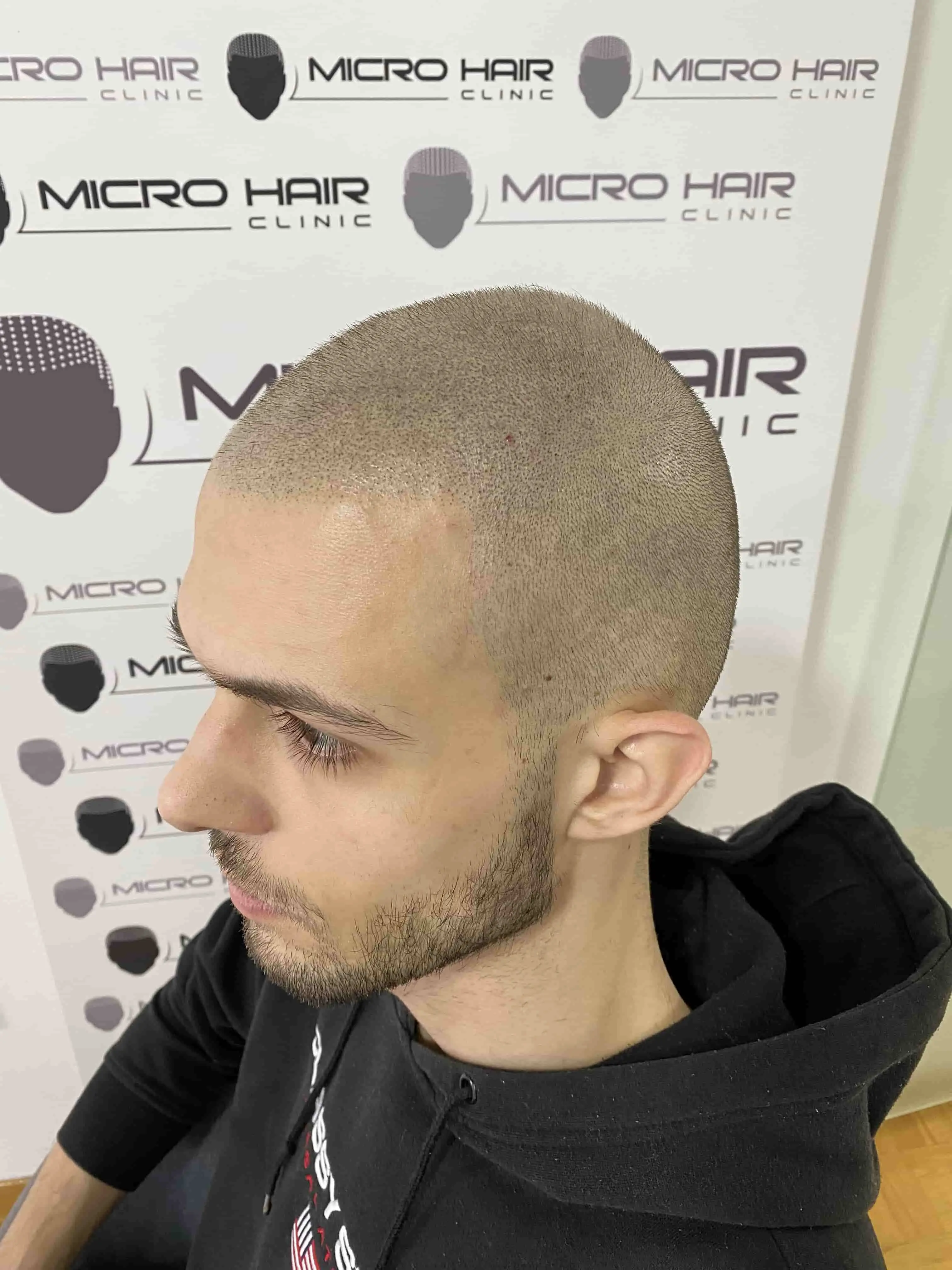 SMP tretman - fotografija iz galerije Micro Hair Clinic