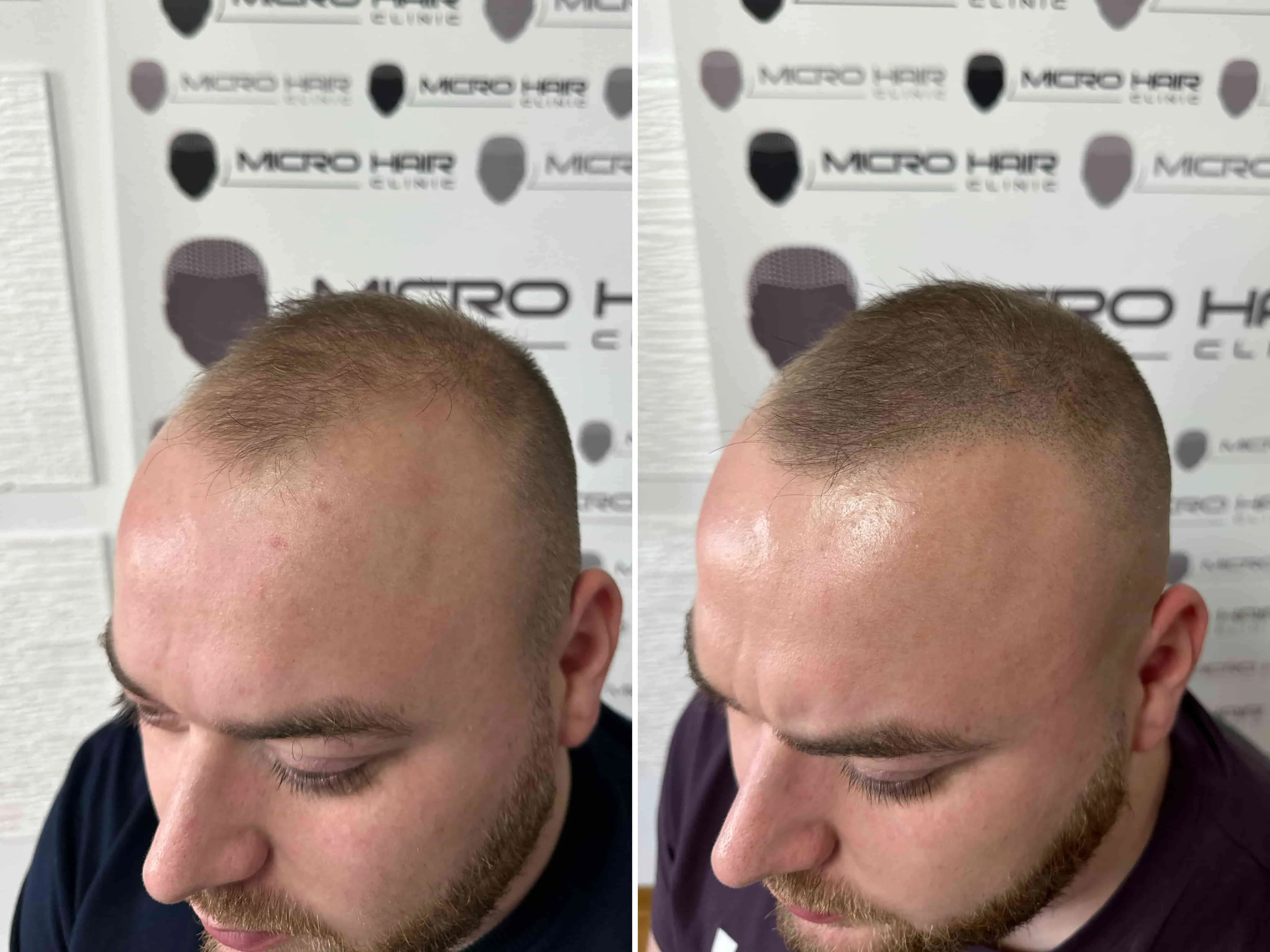 SMP rezultat pred in po - tretman mikropigmentacije 2