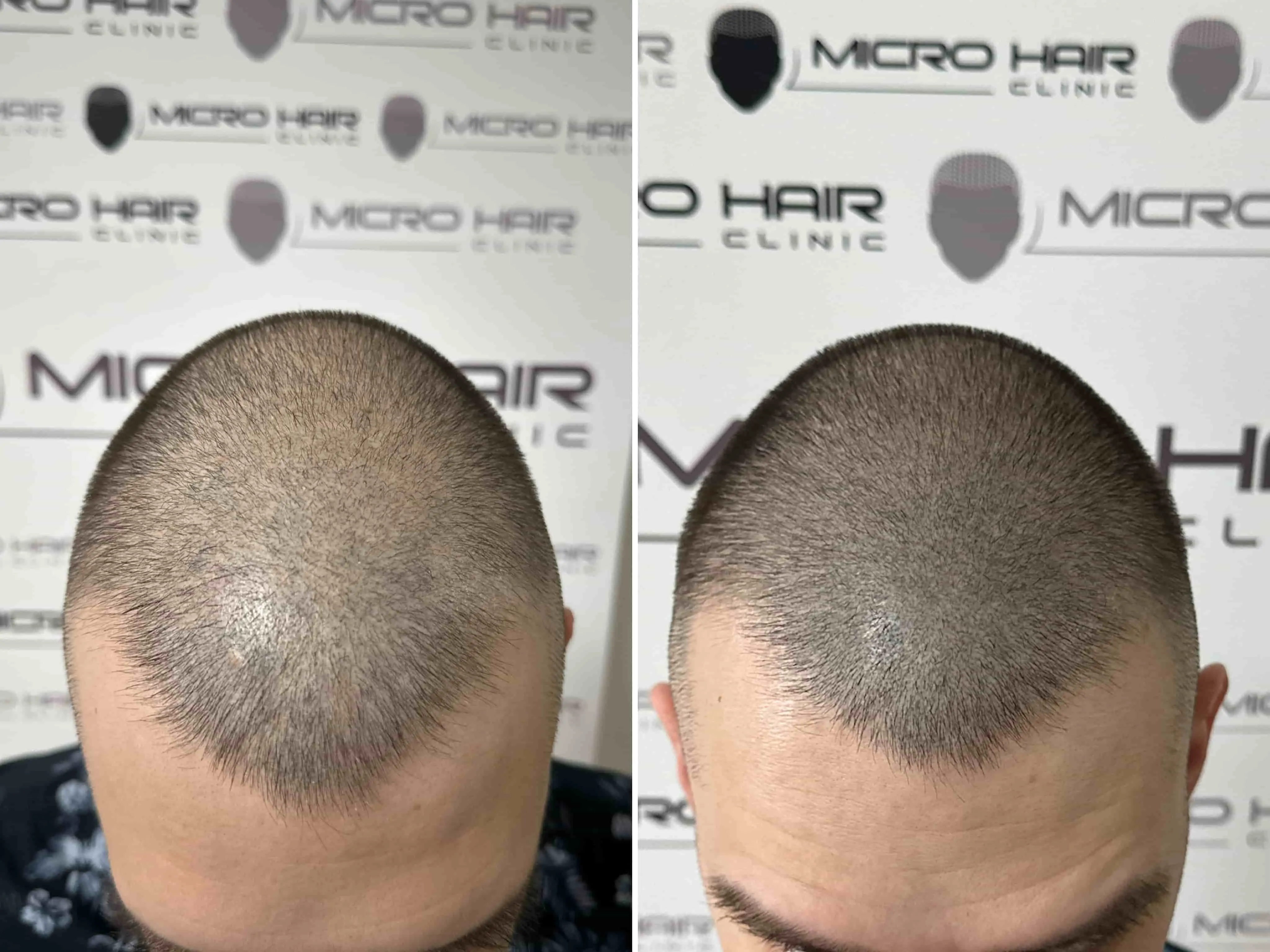 SMP rezultat pred in po - tretman mikropigmentacije 5