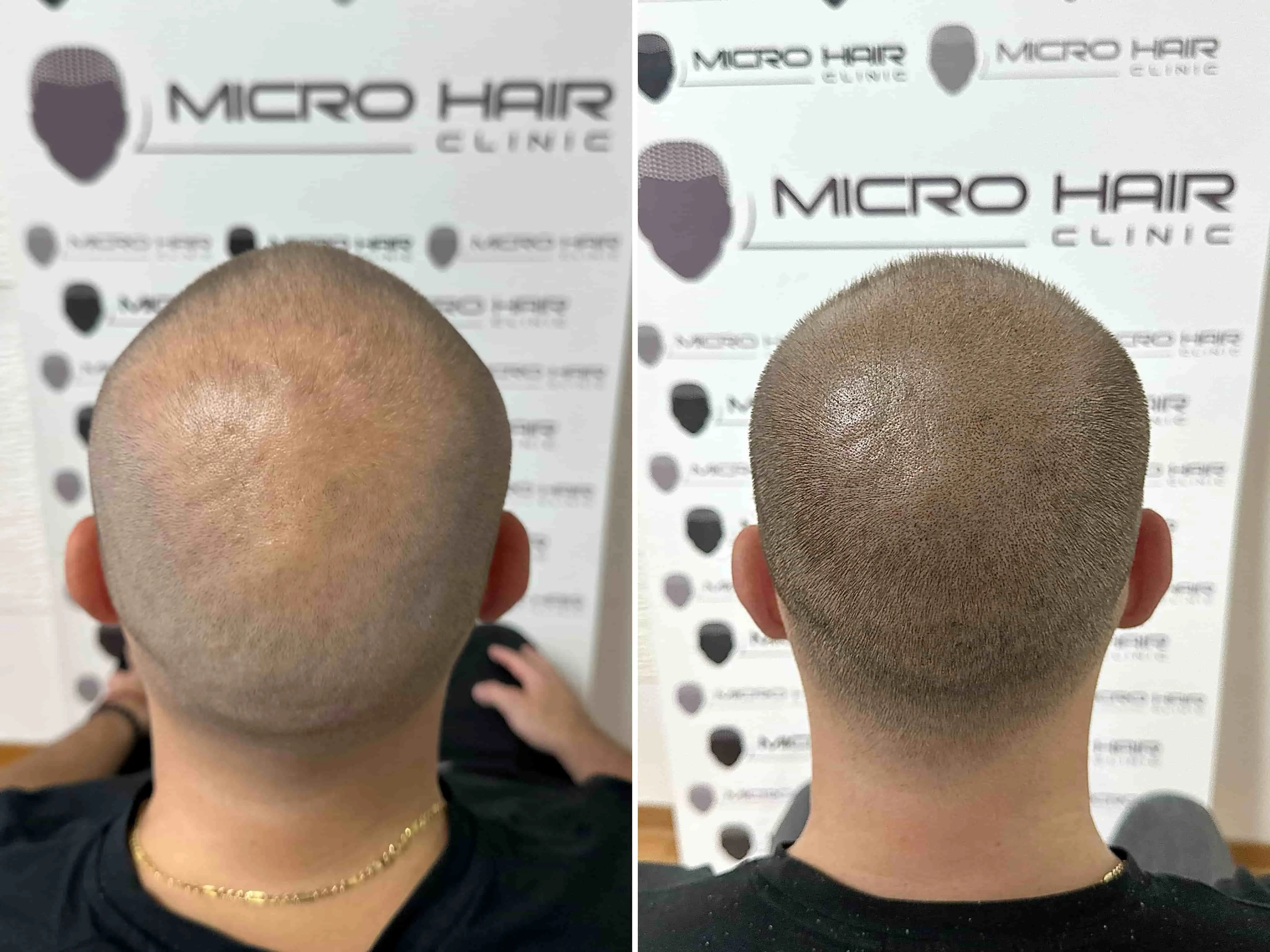 SMP rezultat pred in po - tretman mikropigmentacije 9