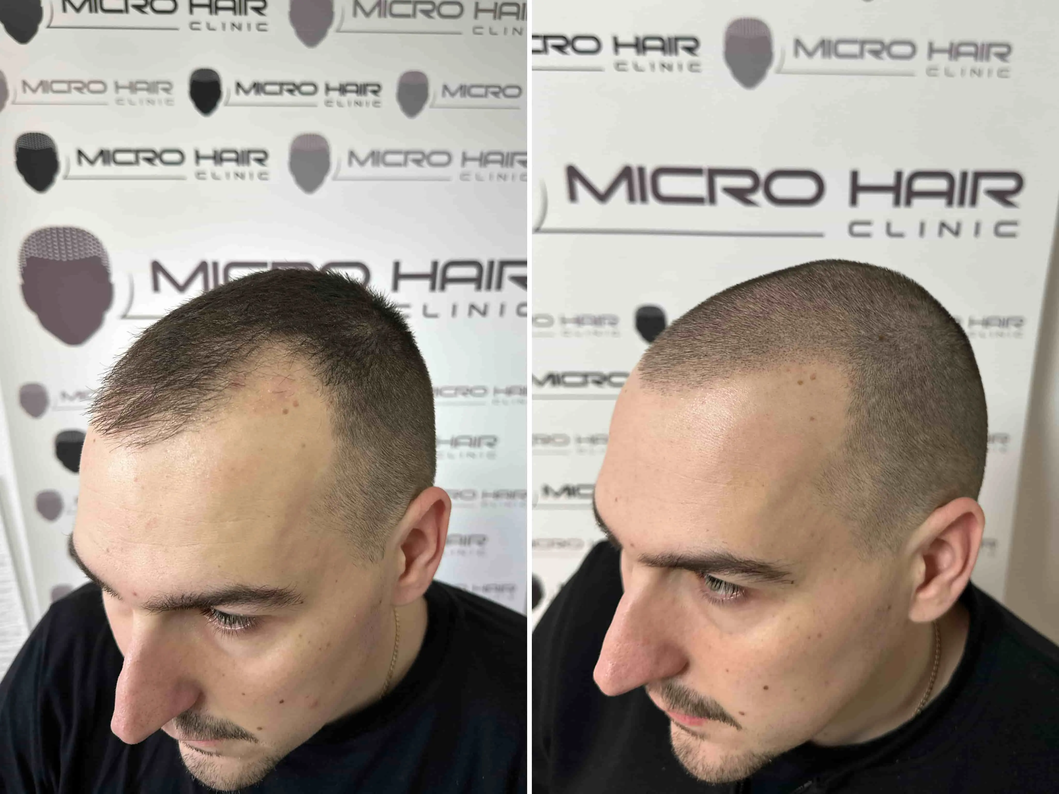 SMP rezultat pred in po - tretman mikropigmentacije 12