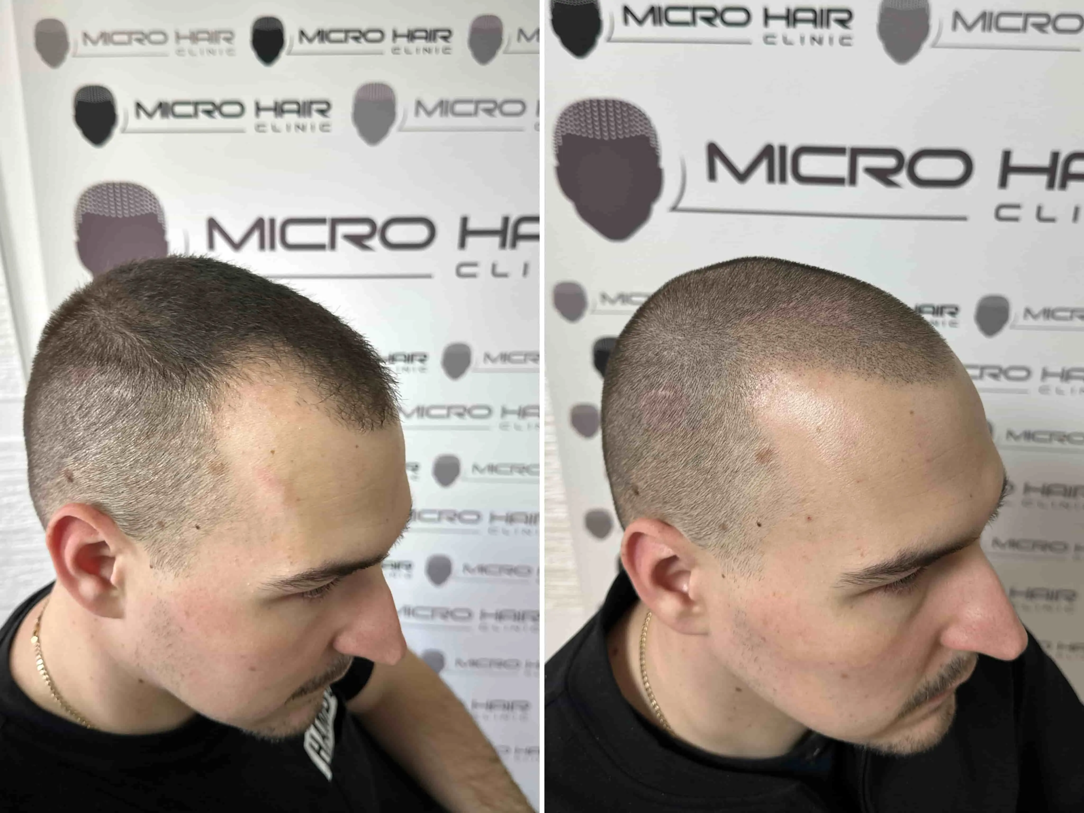 SMP rezultat pred in po - tretman mikropigmentacije 13