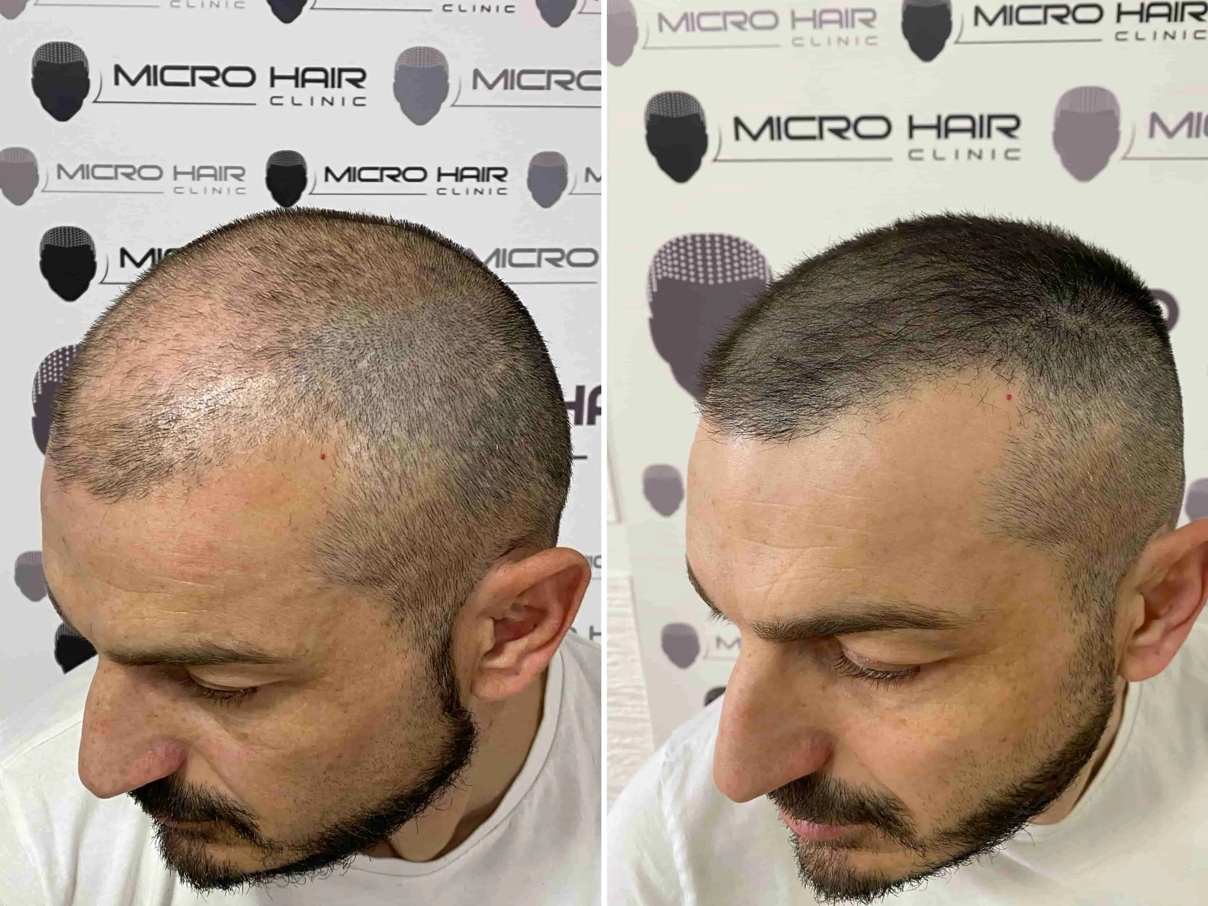 SMP rezultat pred in po - tretman mikropigmentacije 16