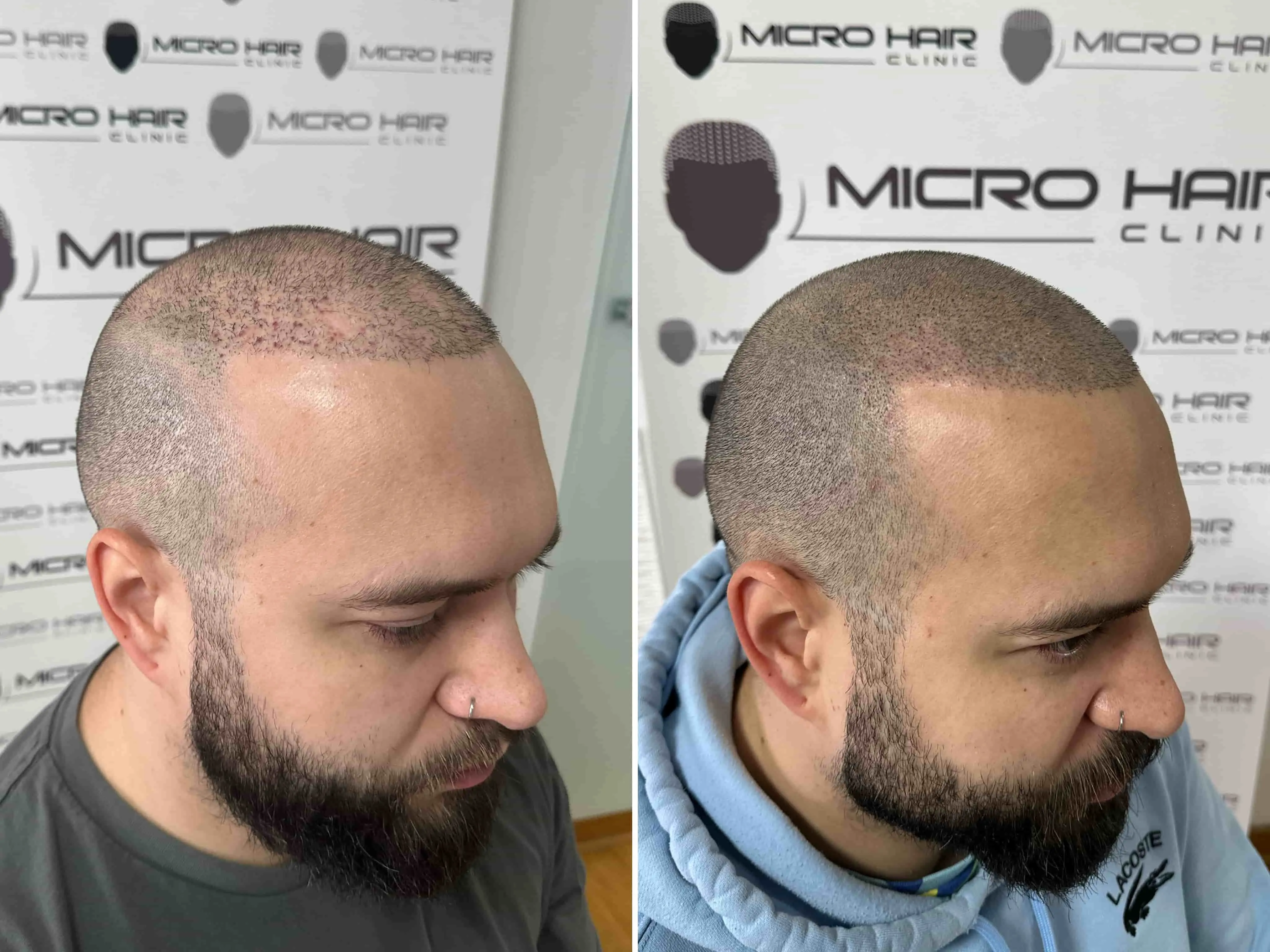 Vrste brazgotin na lasišču mikropigmentacija