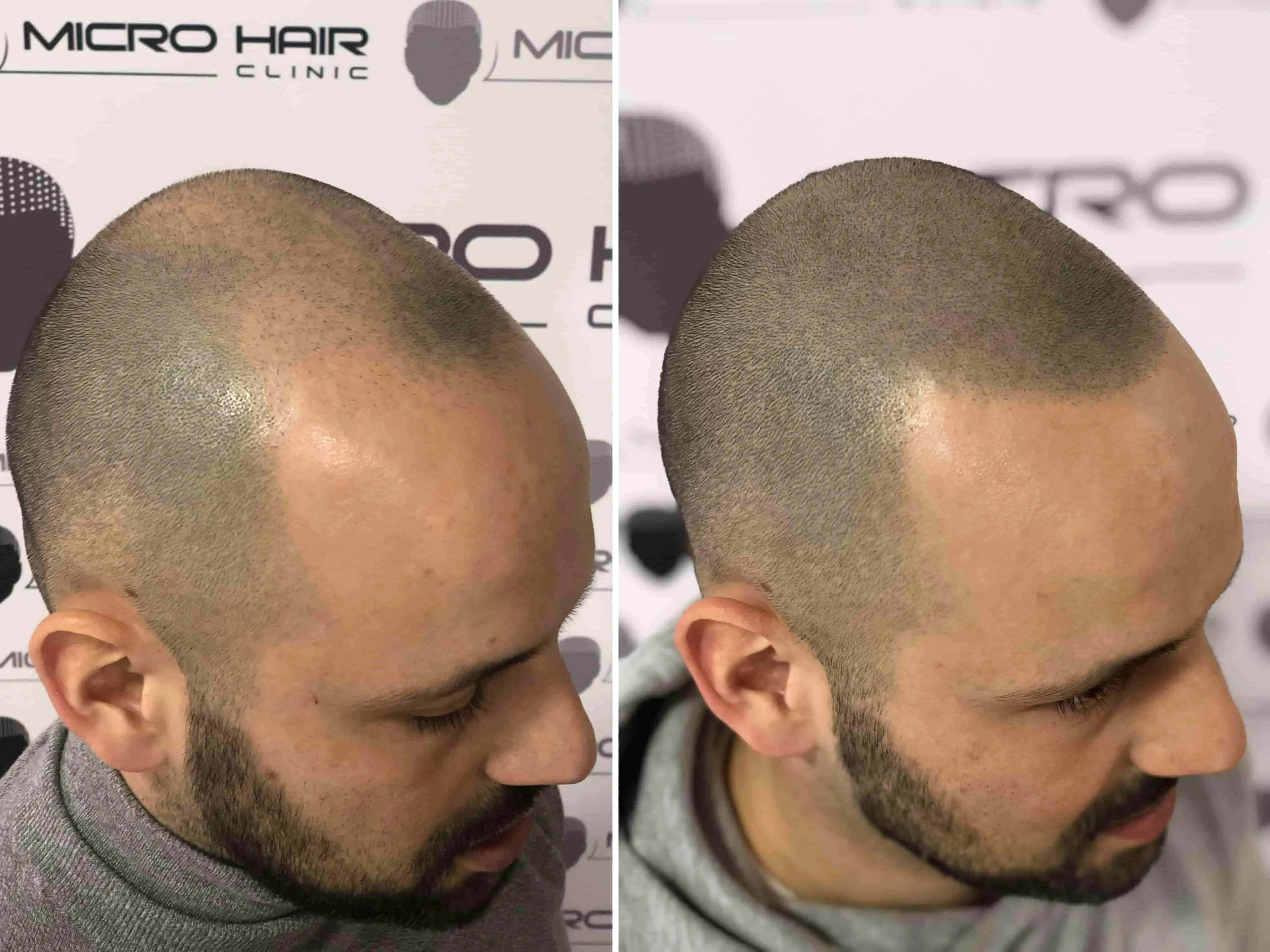 SMP tretma pigmentacija za kamuflažo brazgotine na glavi