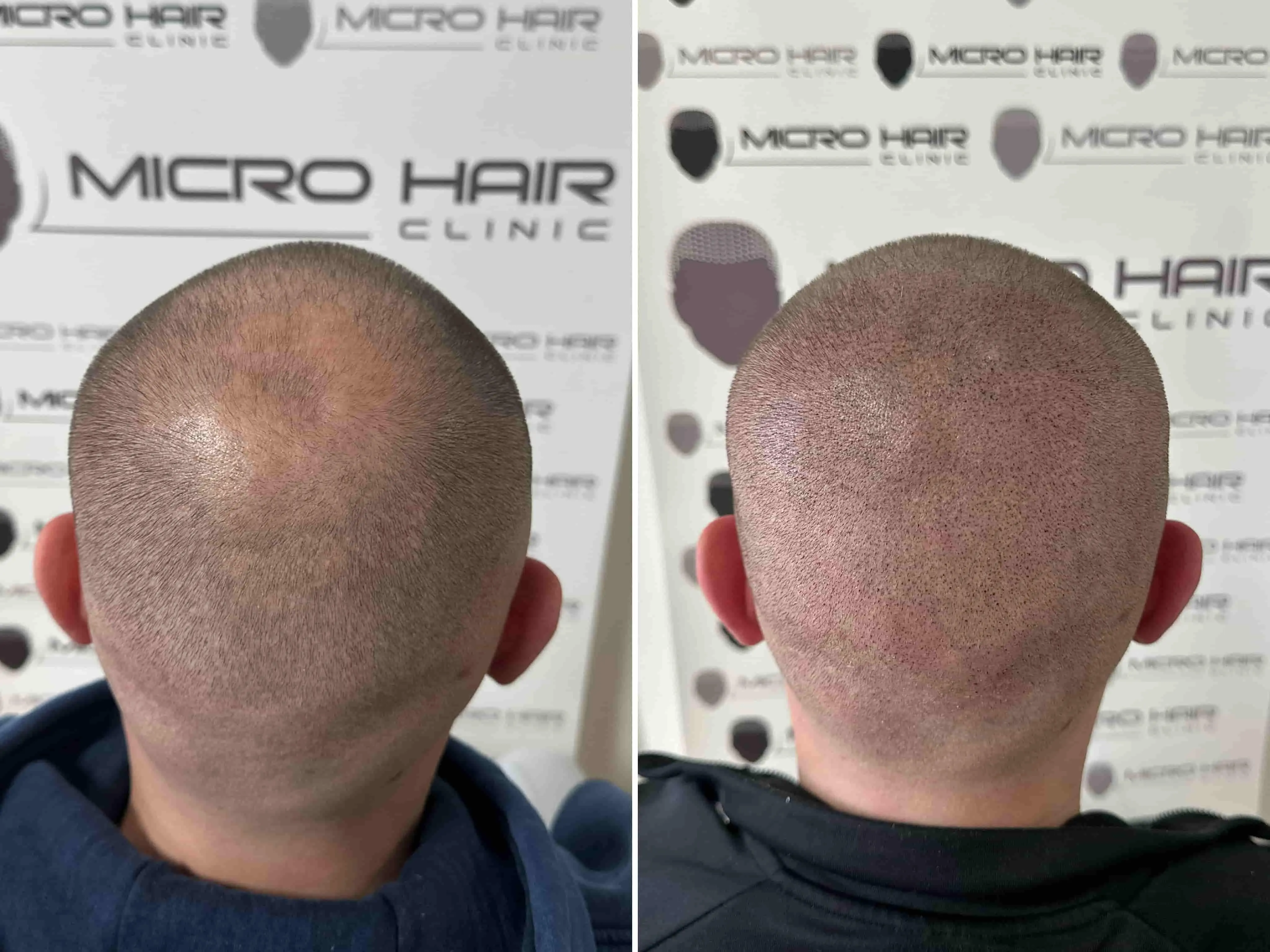 SMP rezultat pred in po - tretman mikropigmentacije 11