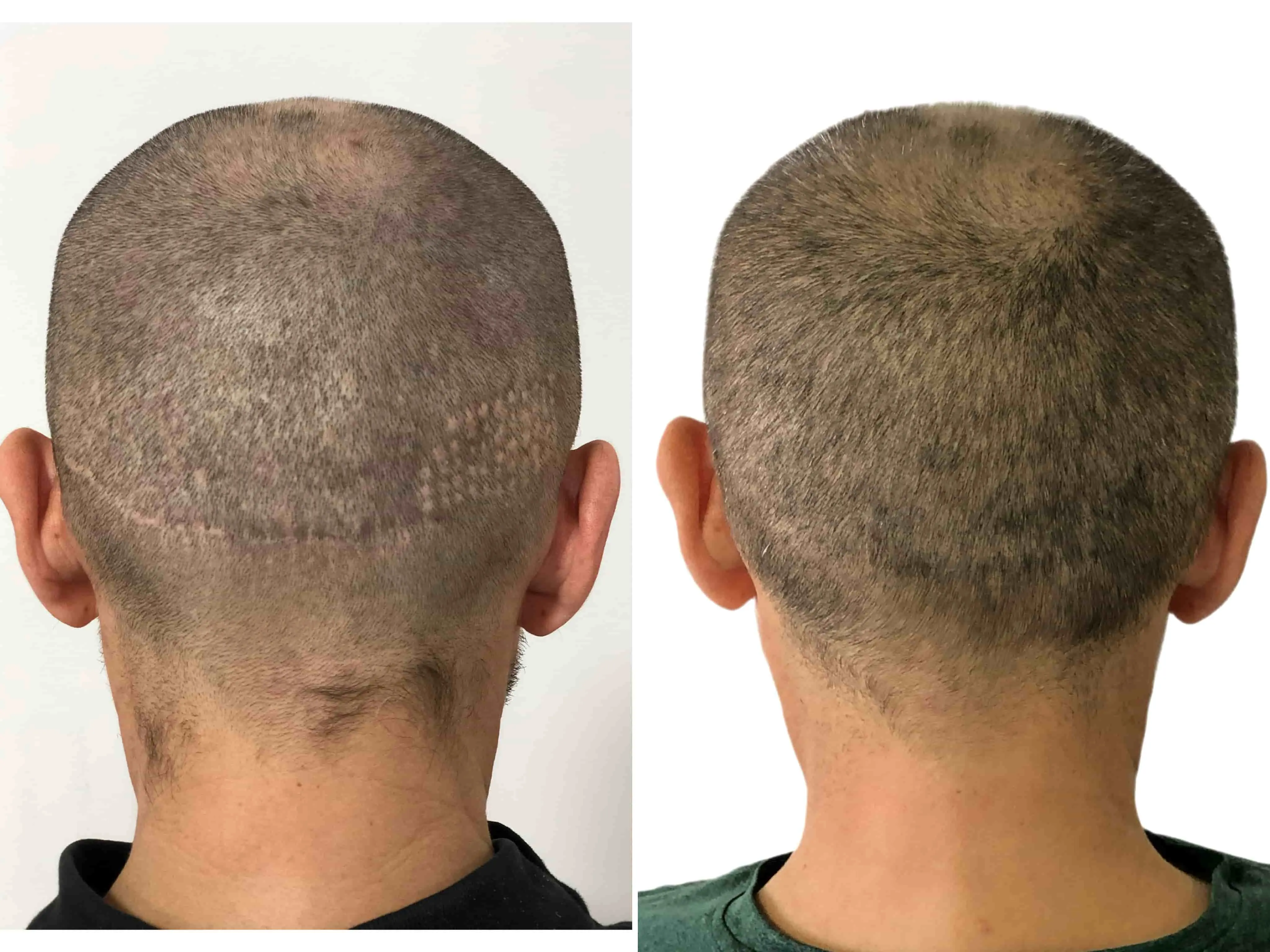 SMP rezultat pred in po - tretman mikropigmentacije 17