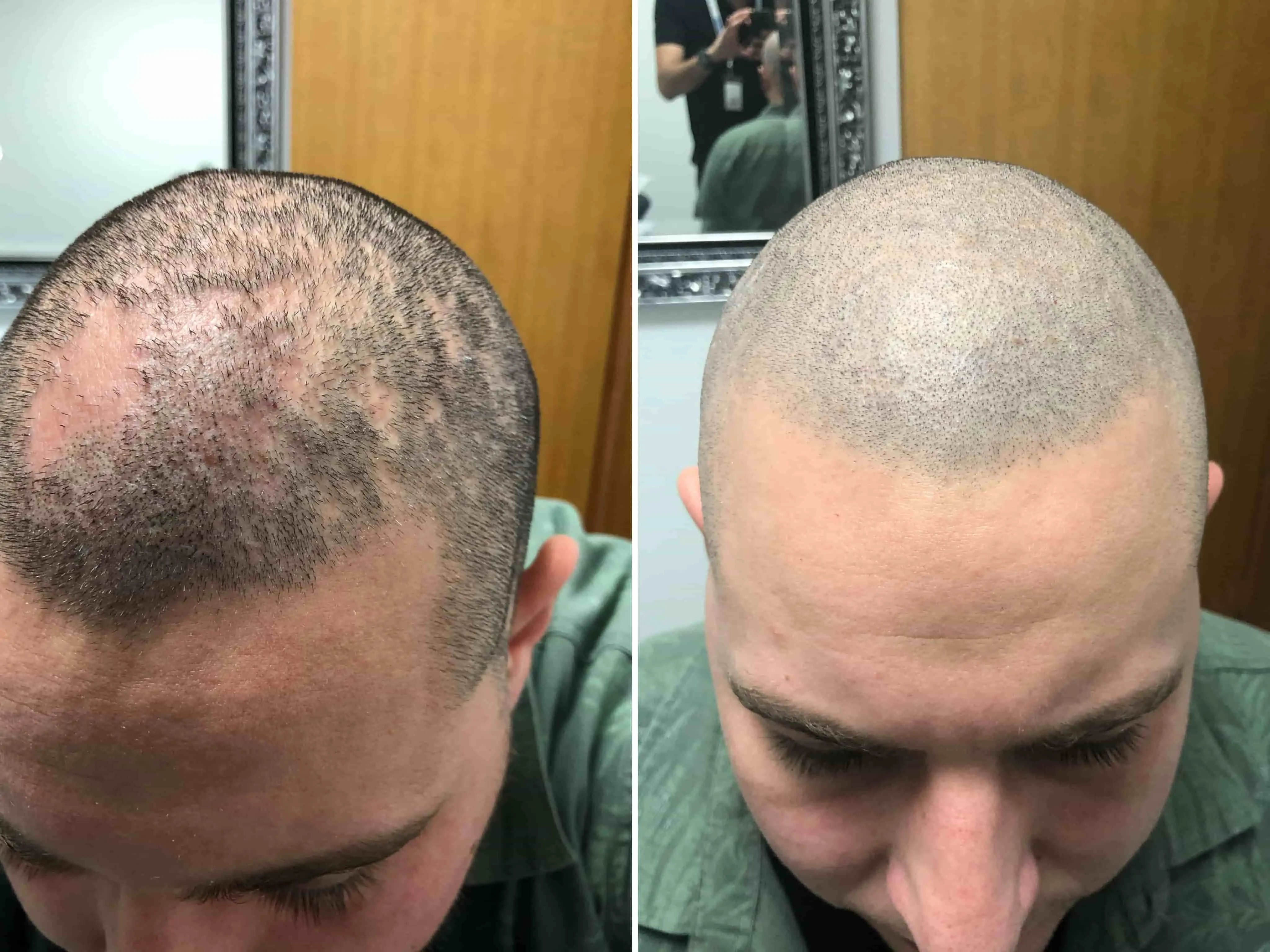 SMP rezultat pred in po - tretman mikropigmentacije 2