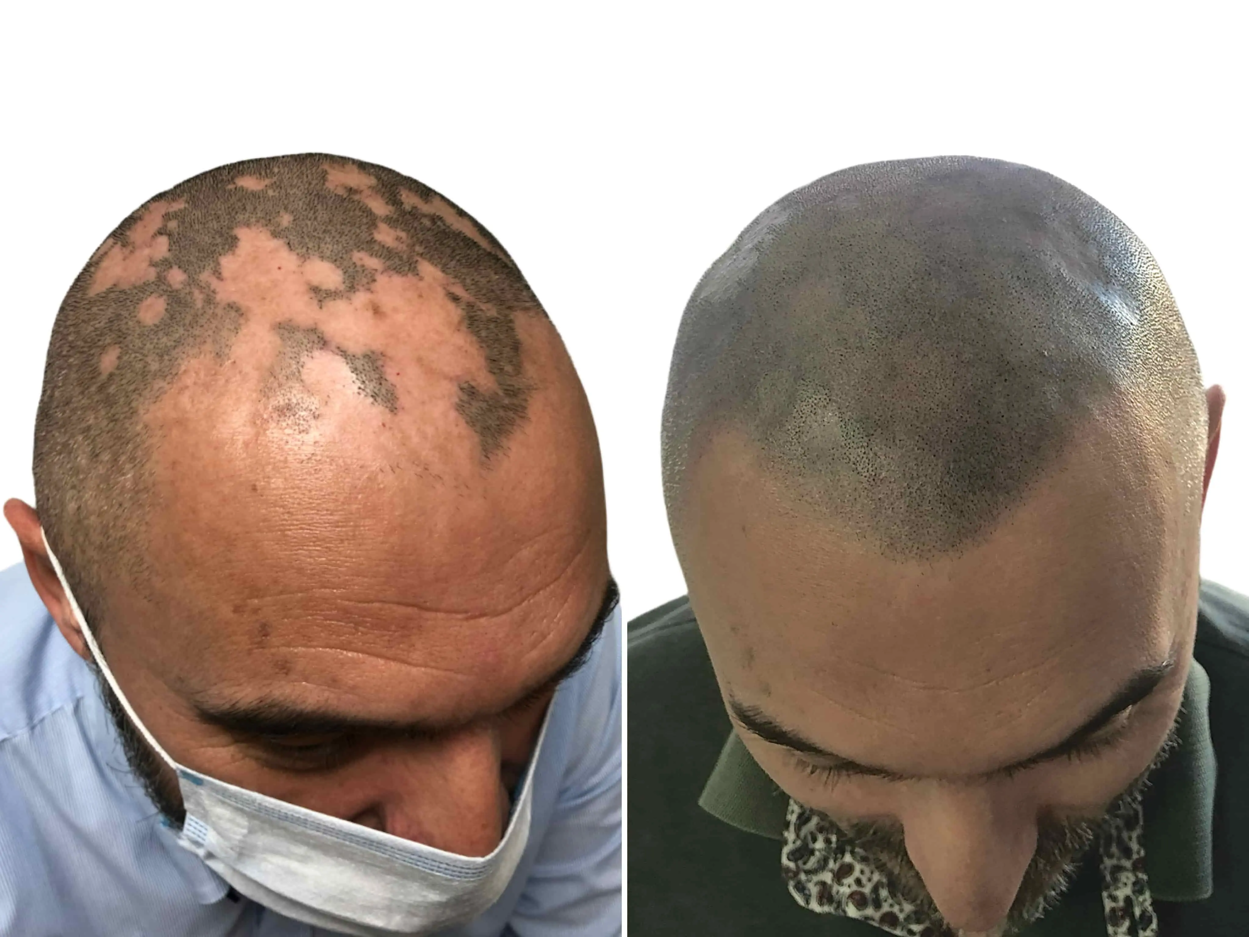 SMP rezultat pred in po - tretman mikropigmentacije 3