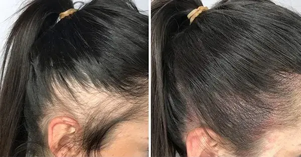 Območja najpogostejšega redčenja las pri ženskah SMP