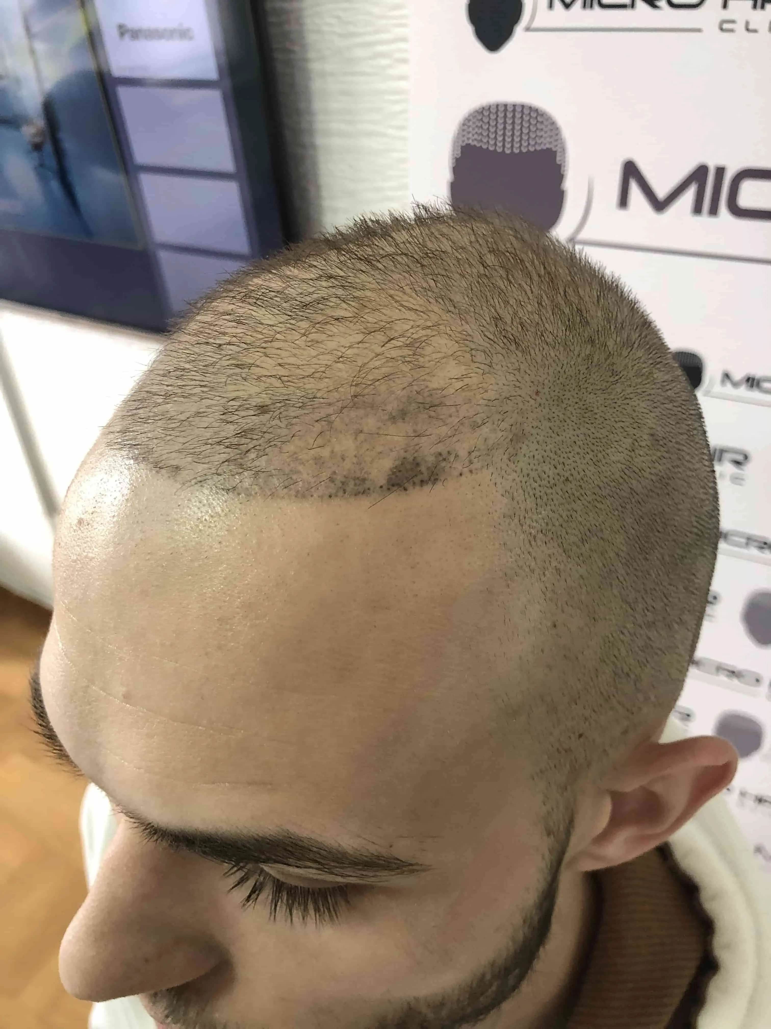 SMP tretman - fotografija iz galerije Micro Hair Clinic