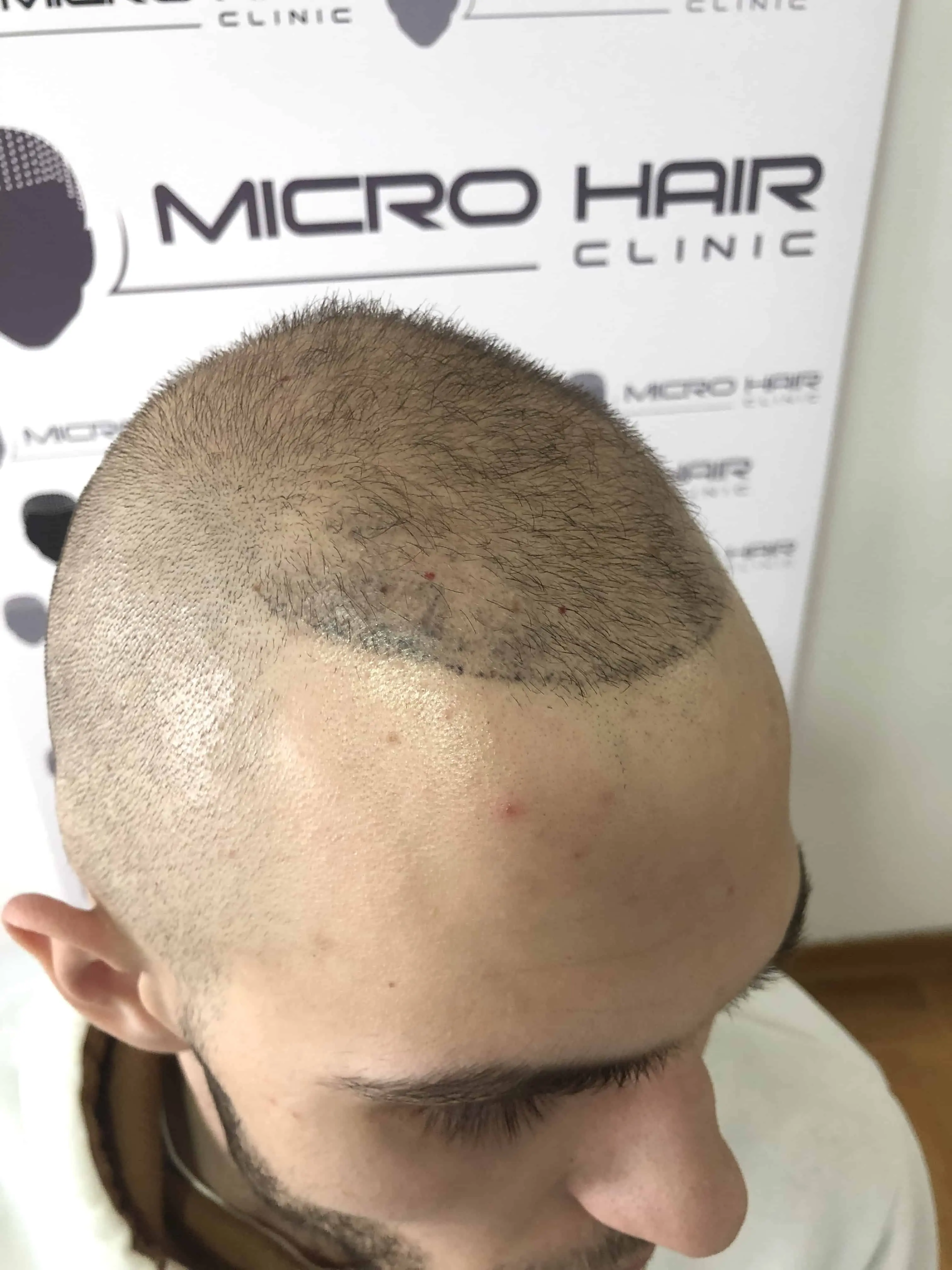 SMP tretman - fotografija iz galerije Micro Hair Clinic