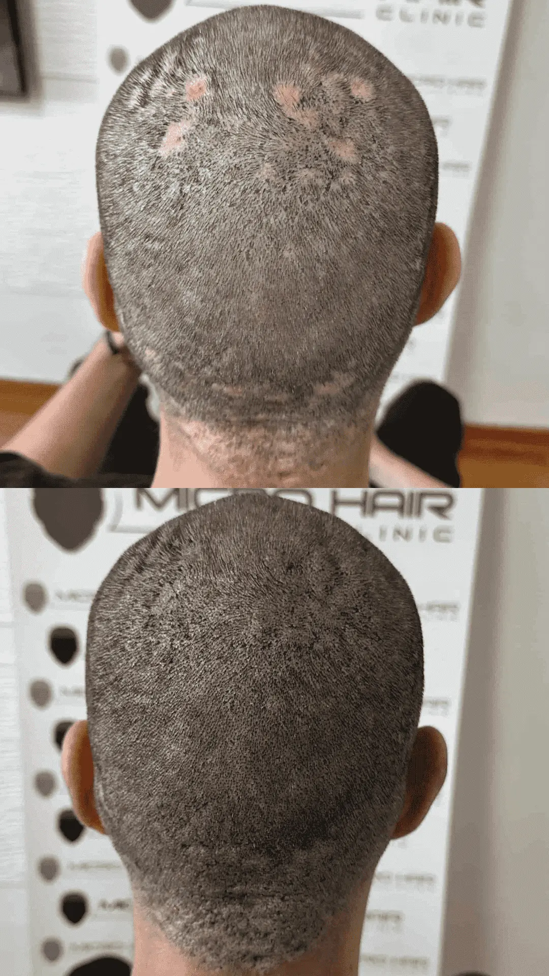 SMP rezultat pri klientu z alopecijo areato