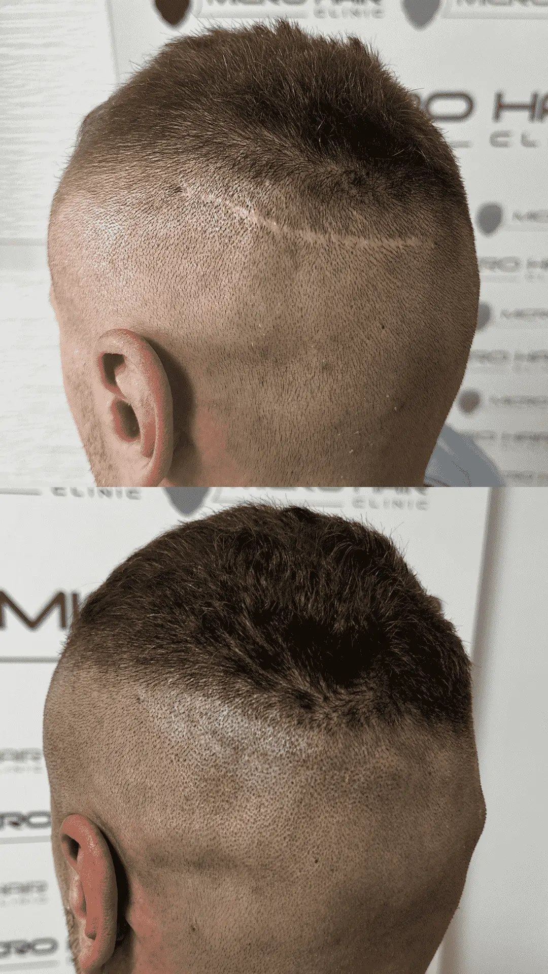 SMP mikropigmentacija rezultat – prekrita brazgotina na lasišču