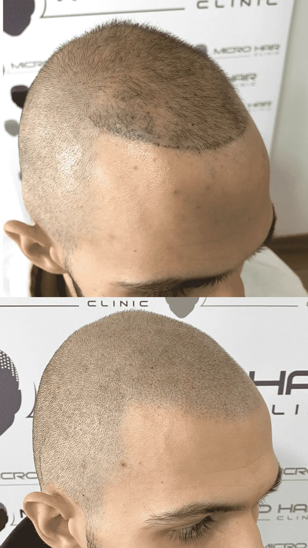 Popravek slabo izvedene mikropigmentacije lasišča – prej in potem