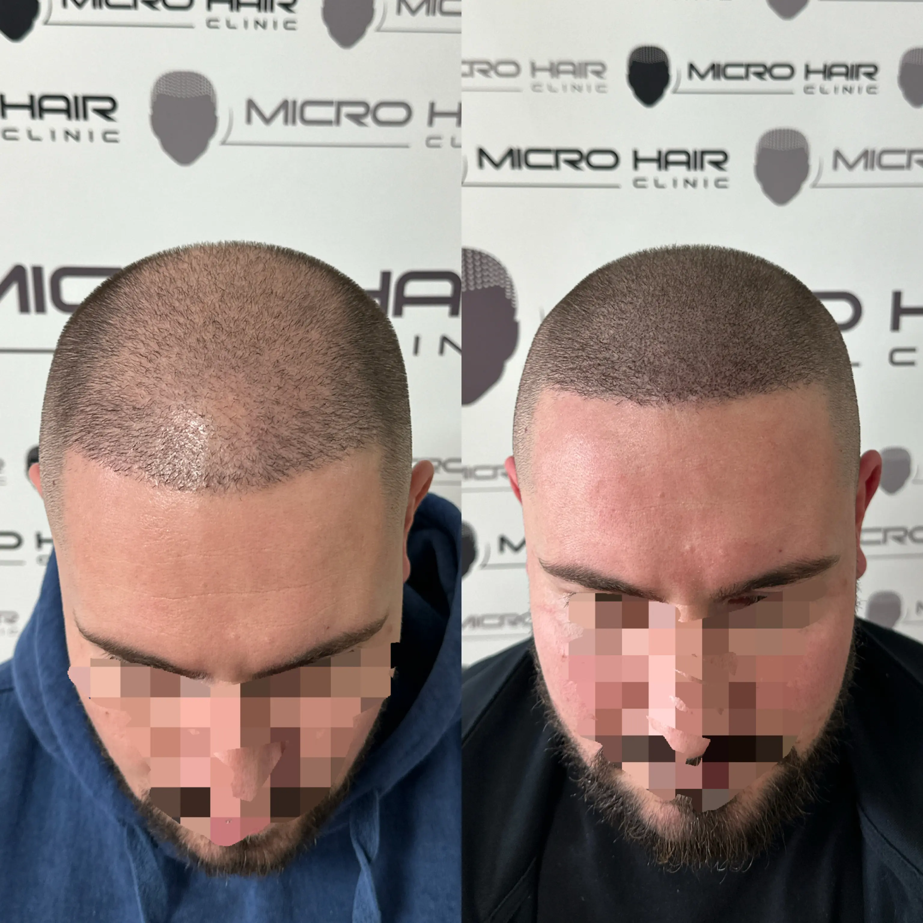 SMP tretman - fotografija iz galerije Micro Hair Clinic