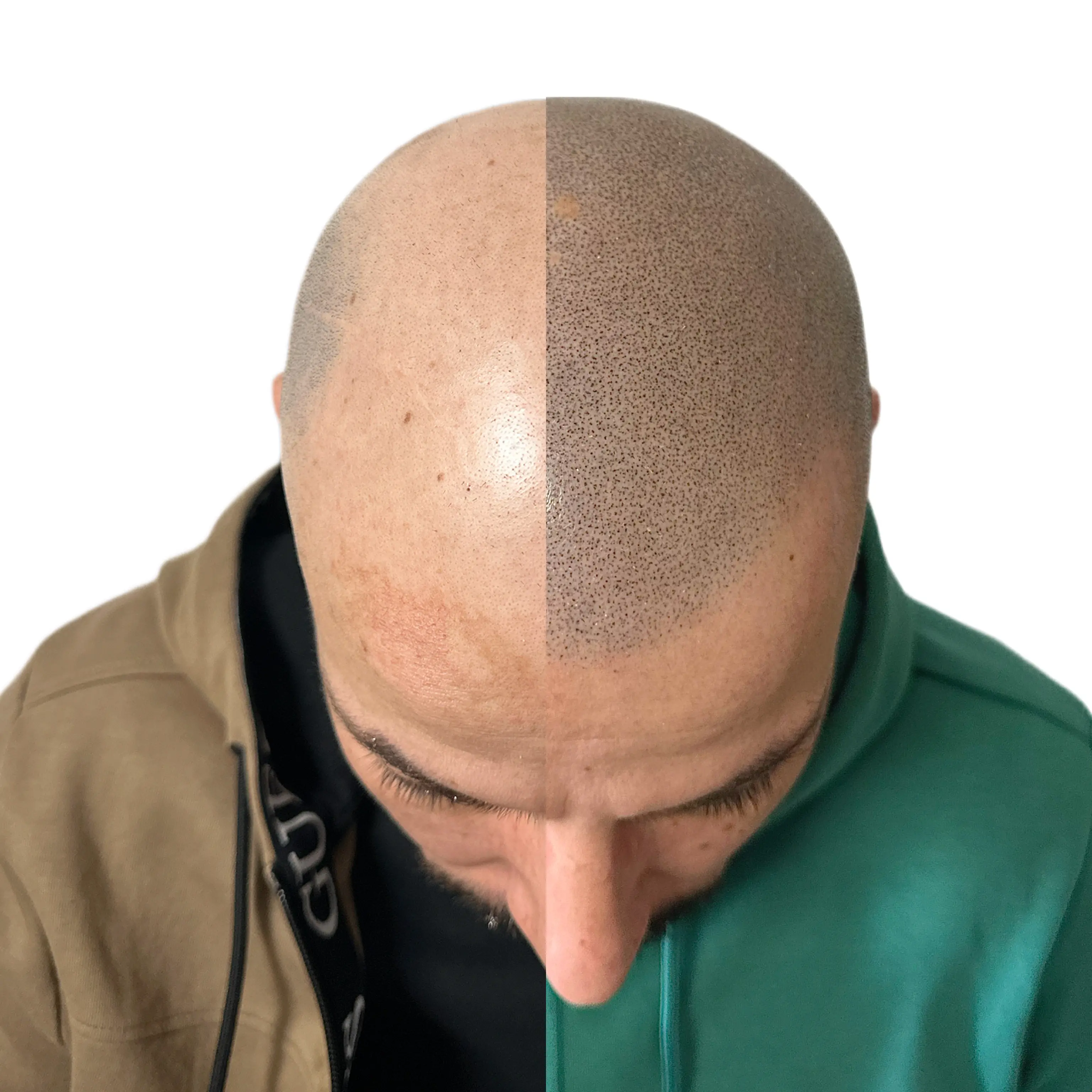 SMP tretman - fotografija iz galerije Micro Hair Clinic