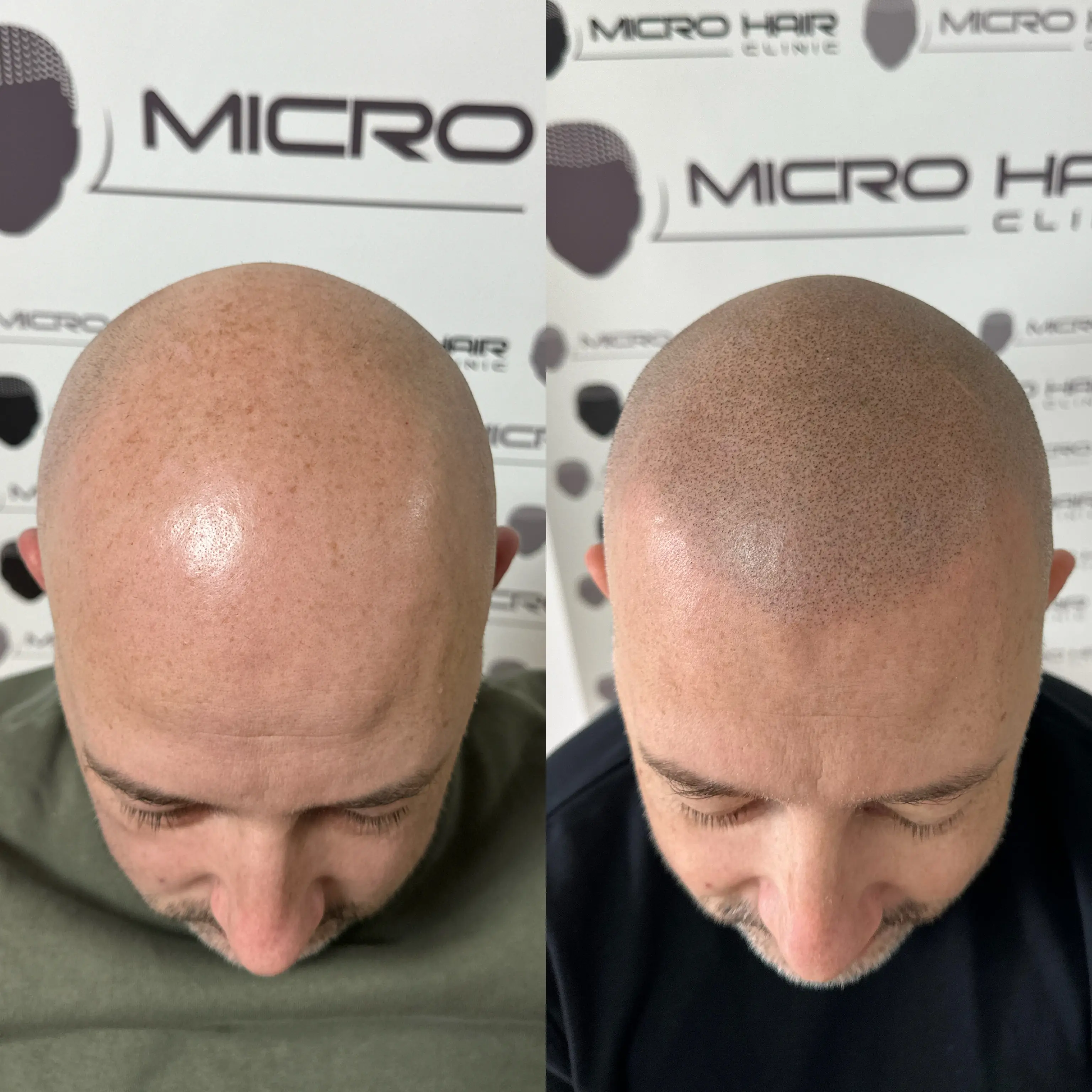 SMP tretman - fotografija iz galerije Micro Hair Clinic